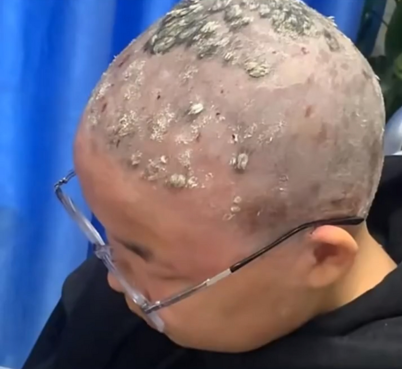 牛皮癣扎根在头上,是体内有火,一个方法浇灭它!  中医讲,大部分的牛皮