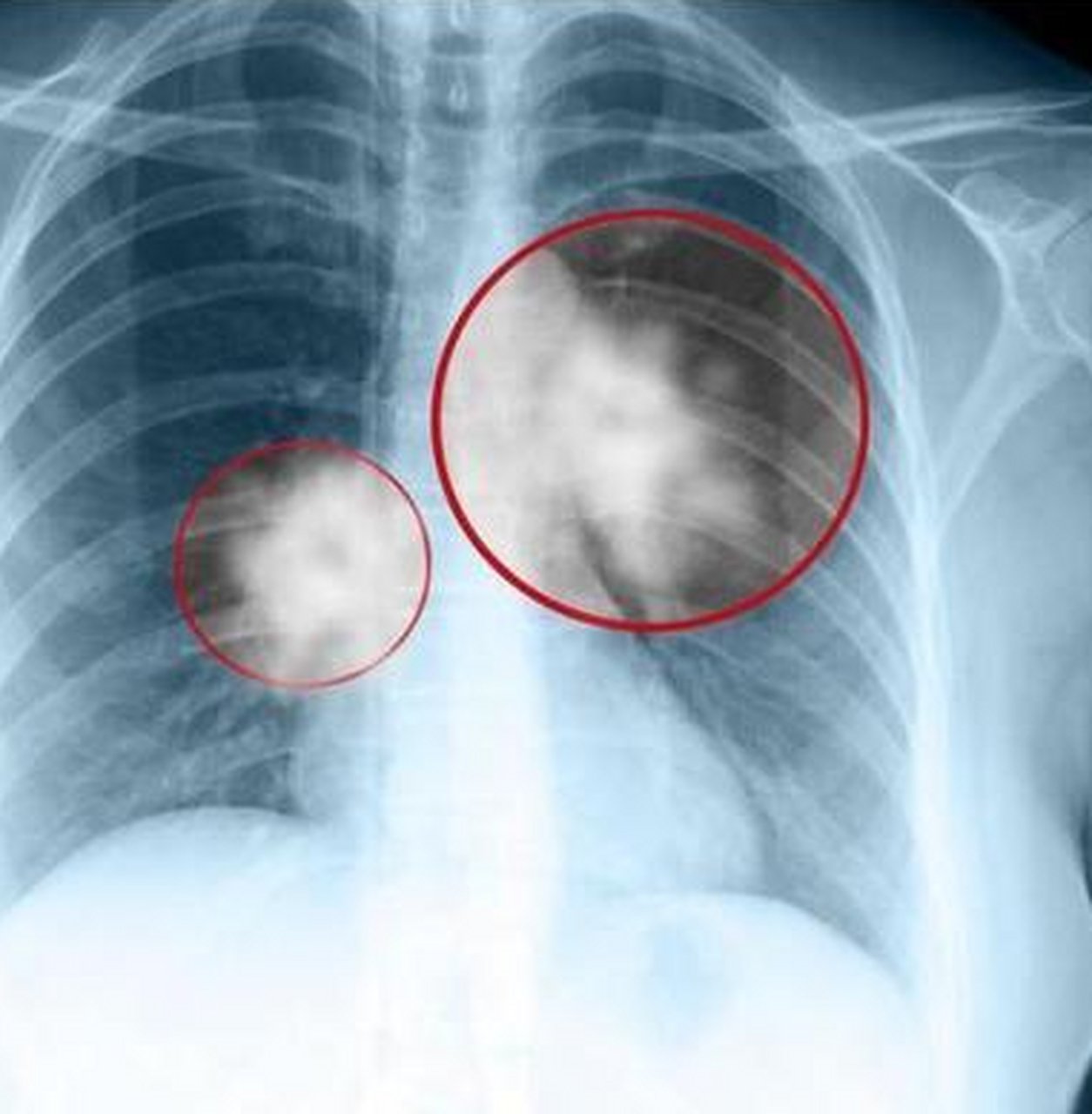 "本人男,44岁,戒烟3个月,最近咳出来的痰是褐色的