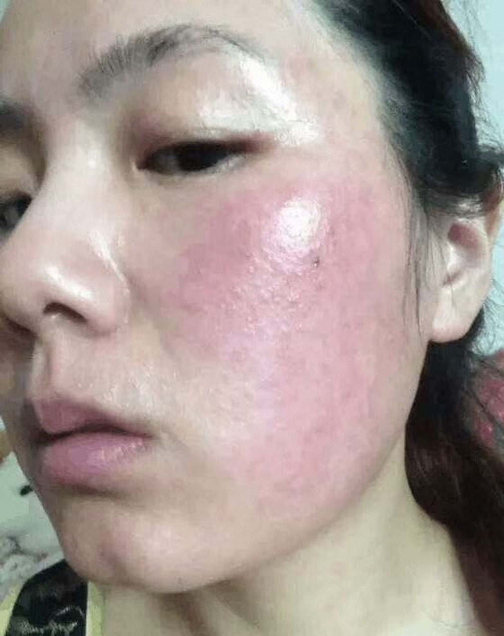 激素皮肤怎么能恢复到正常皮肤?