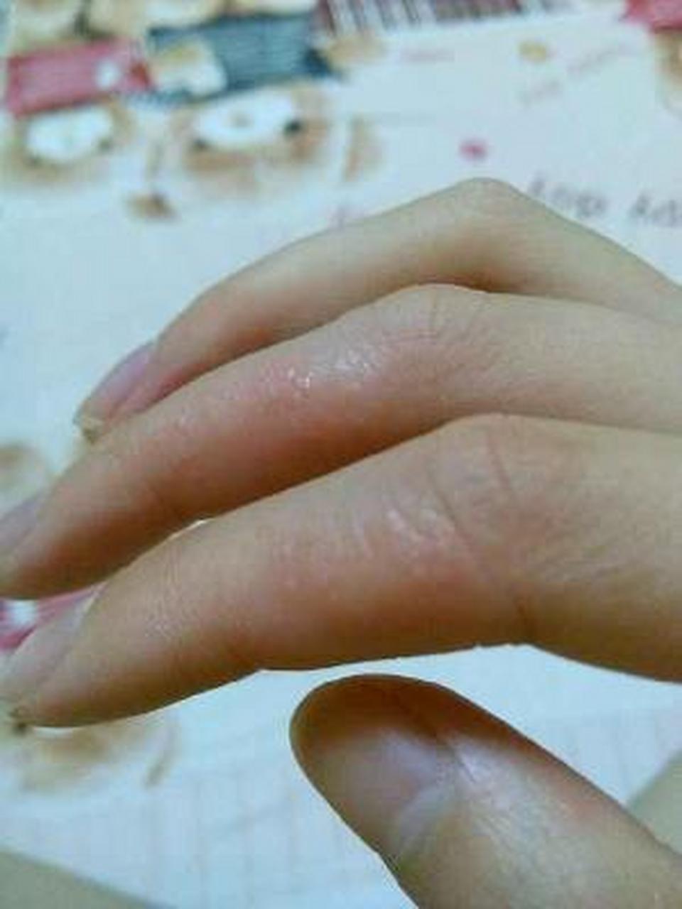 为什么手指上会起小泡
