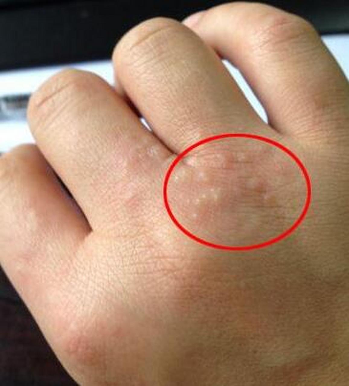 手上长"小水泡",看起来瘆人,不仅很痒,挠破后会有液体流出,你知道导致