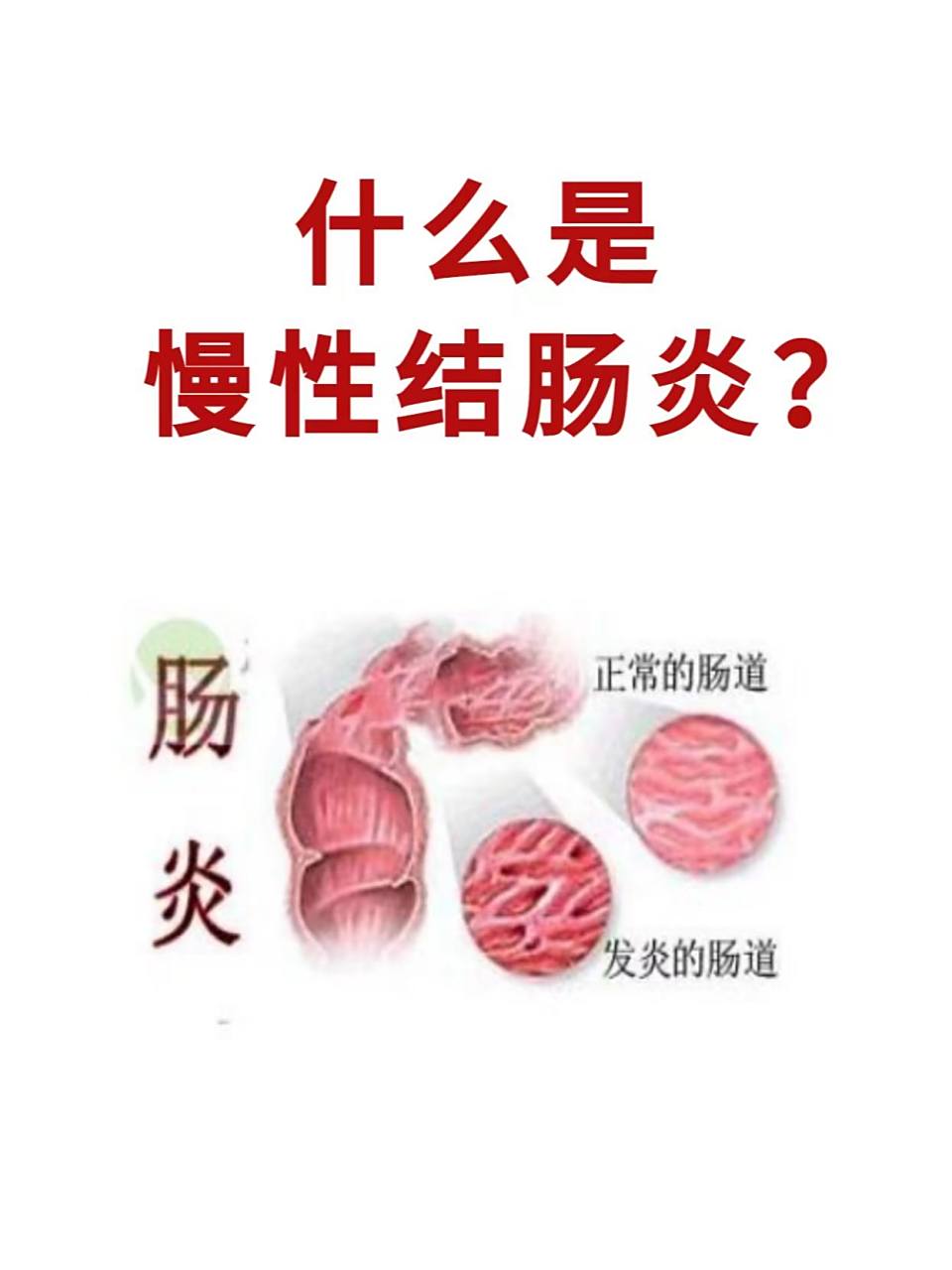 慢性结肠炎是一种慢性,反复性,多发性,因各种致病原因导致的肠道炎