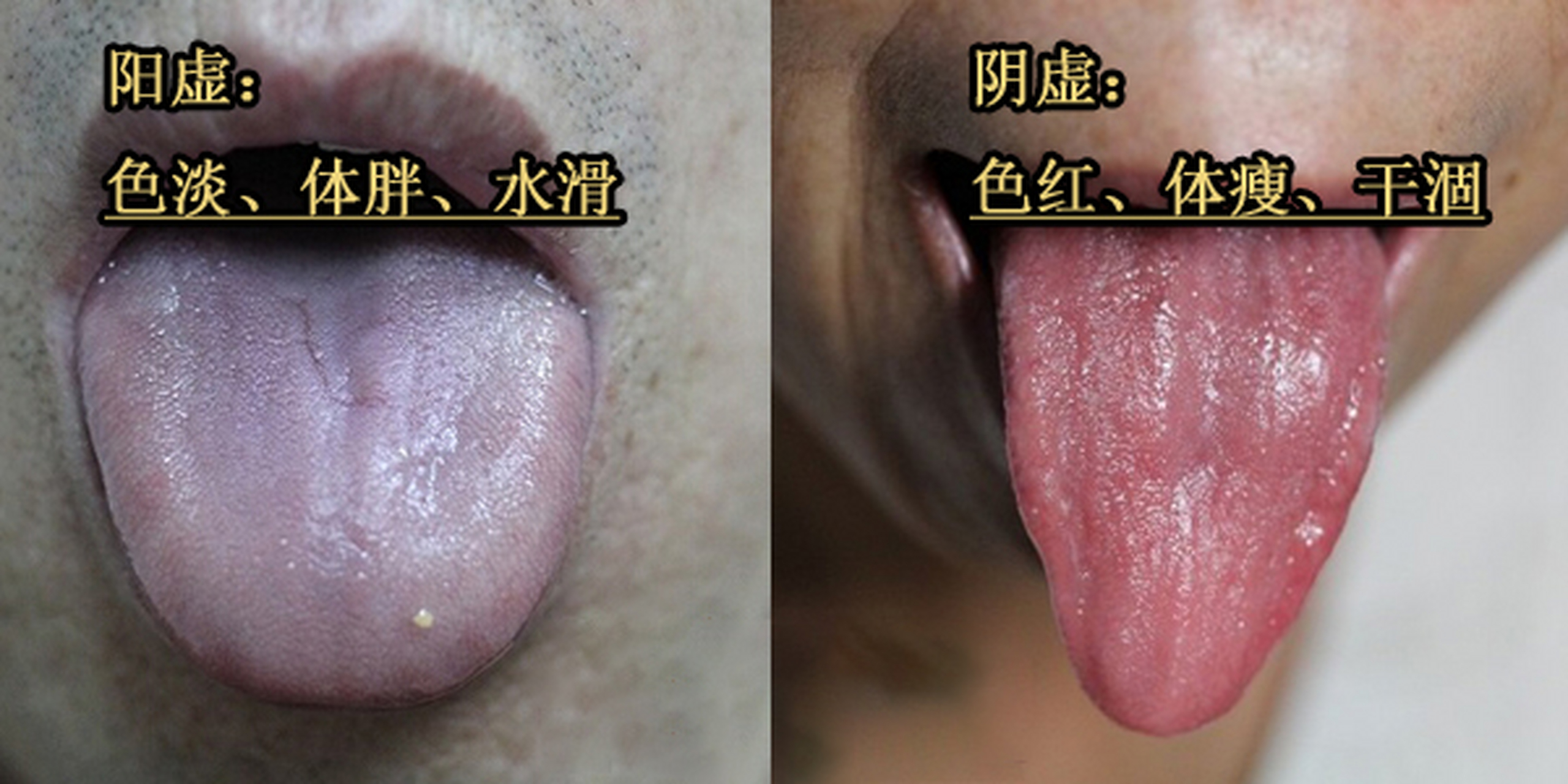 正常人的舌象为淡红舌,薄白苔; 如果出现舌质淡,舌体胖大,苔水滑