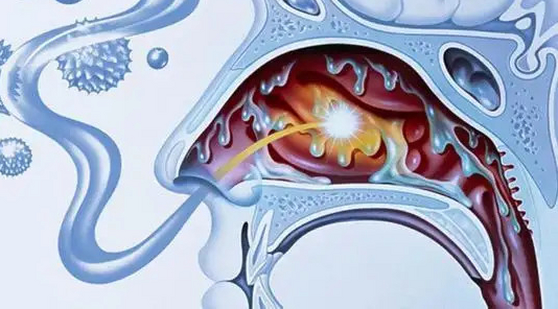 听起来人畜无害的干酪性鼻炎,真实面貌竟是这样的 干酪性鼻炎是一种由