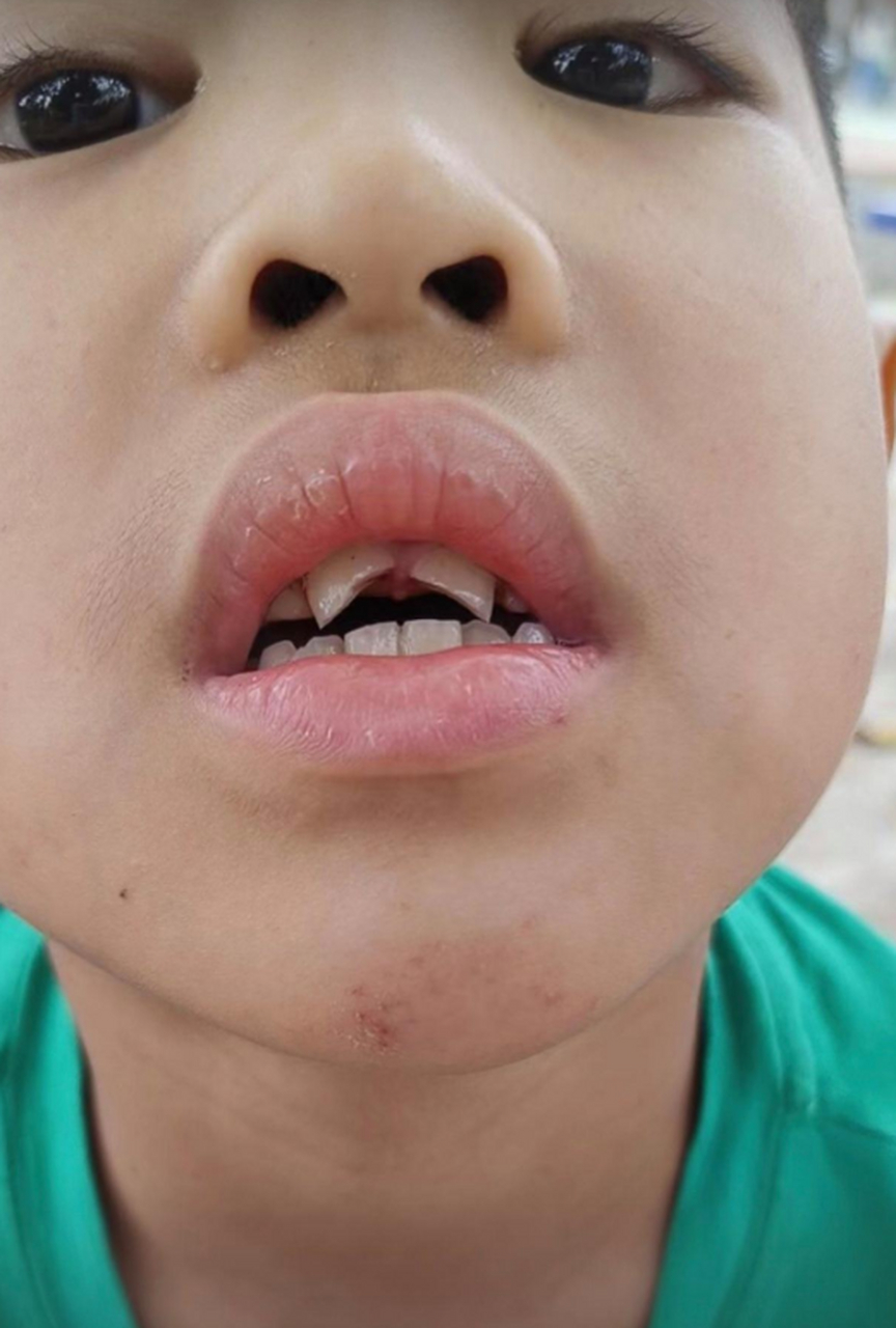 小孩子撞到两颗门牙了,有没有办法整好?