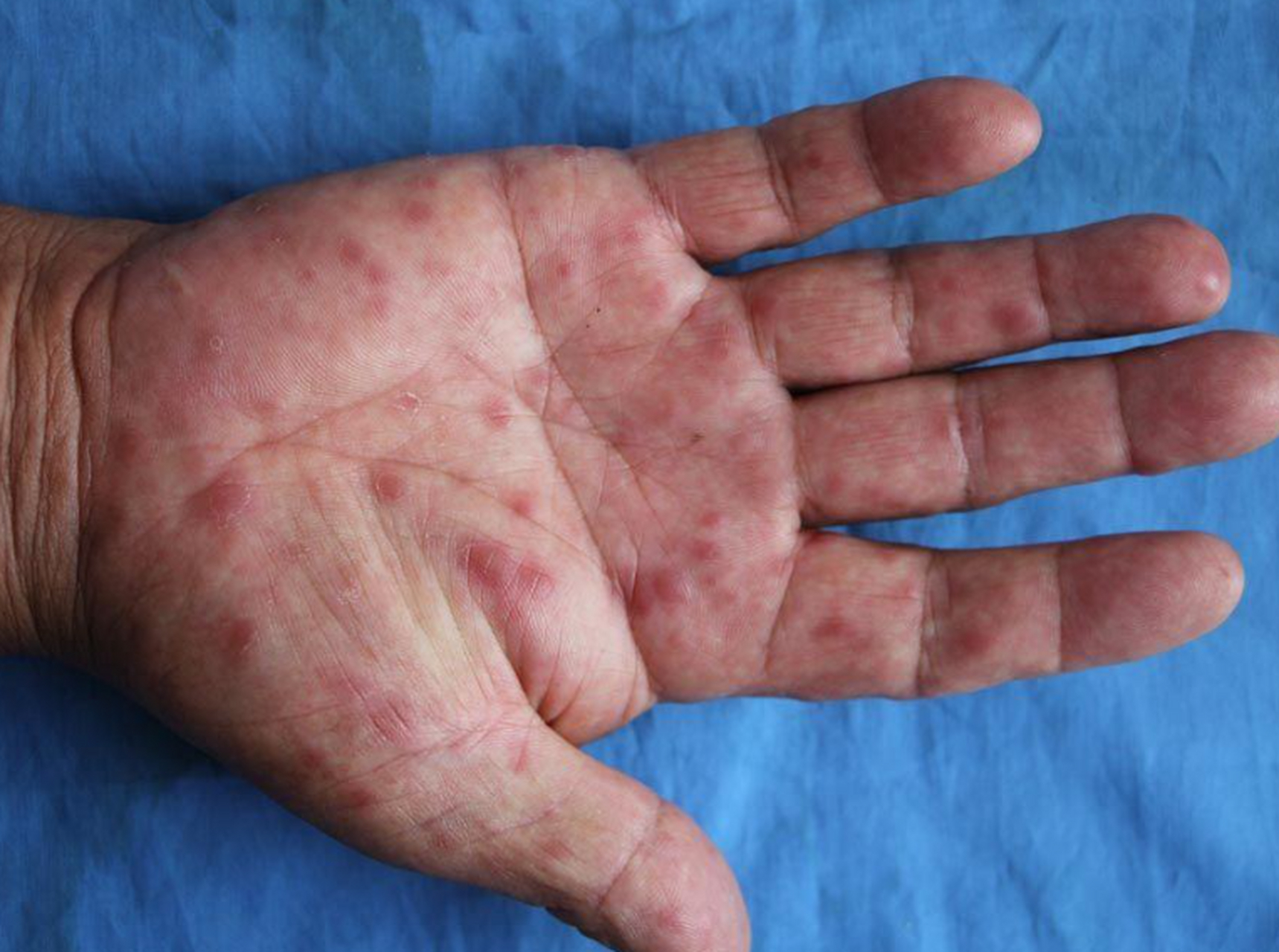 真是奇了怪了,我一辈子清清白白,怎么得了梅毒呢?