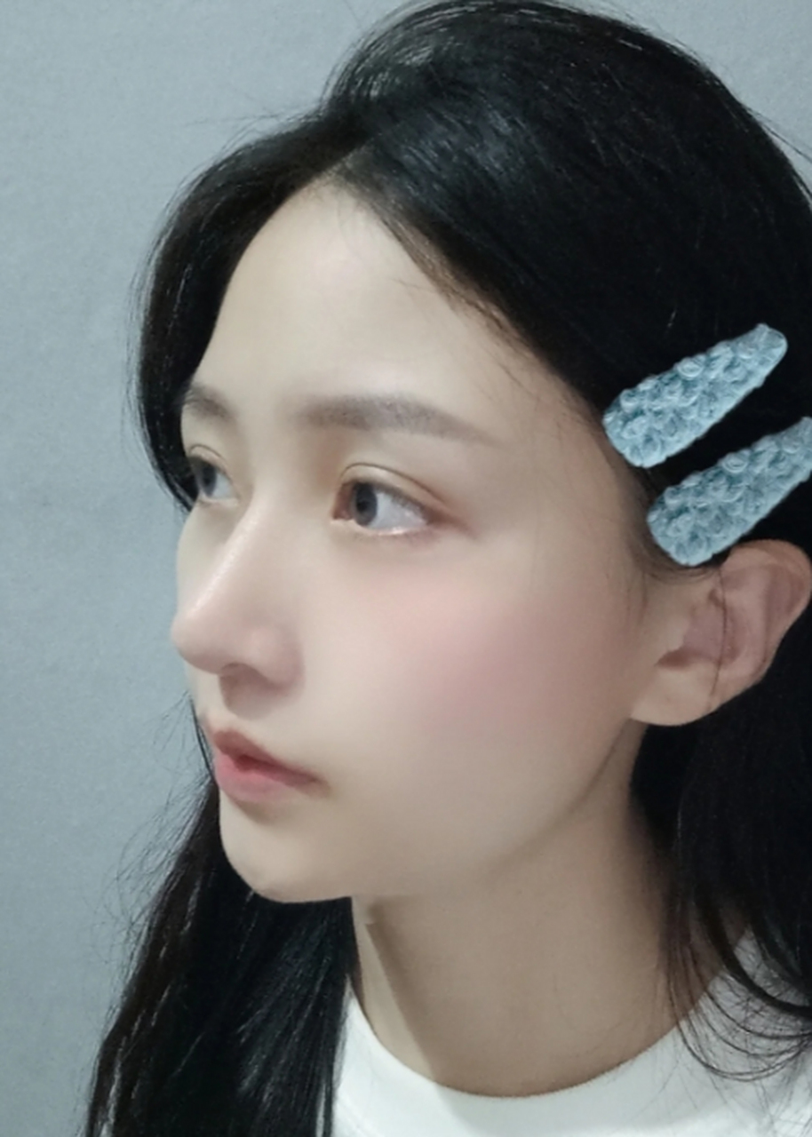 膨体隆鼻是一种比较常见的隆鼻方法,它通过将一定量的膨体植入到鼻子