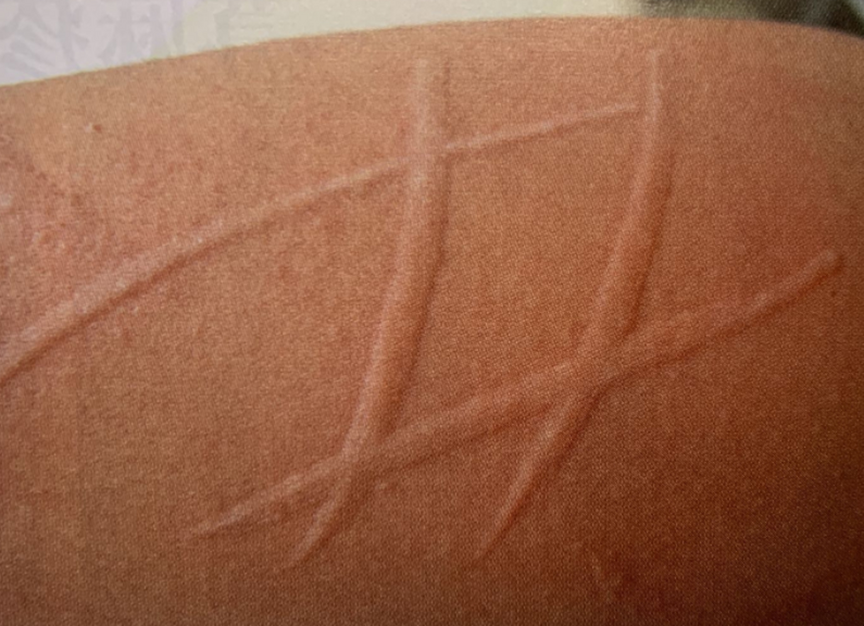 人工型荨麻疹是一种治疗荨麻疹的方法,是在医生的监护下刺激皮肤引起