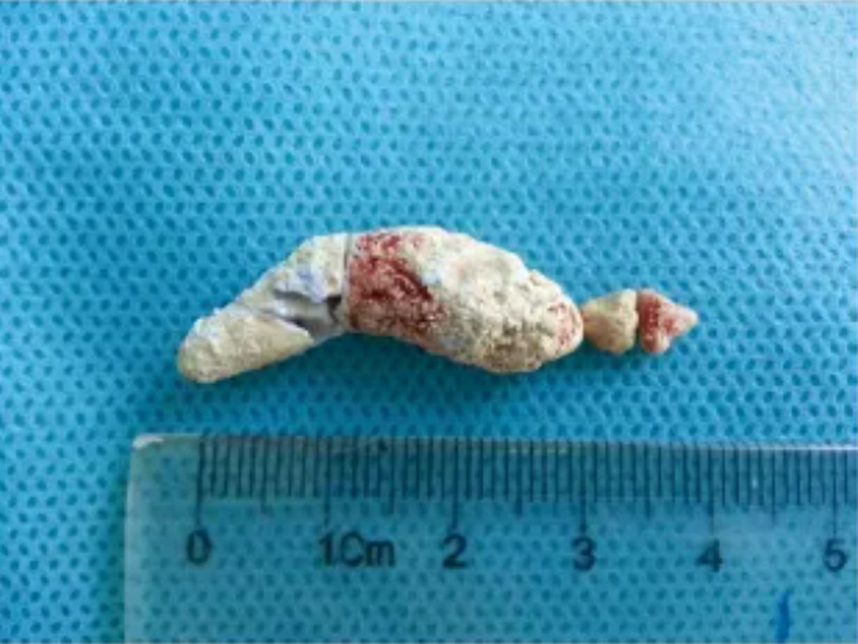 32岁的男子,舌头下长了个包块,以为是发炎了.