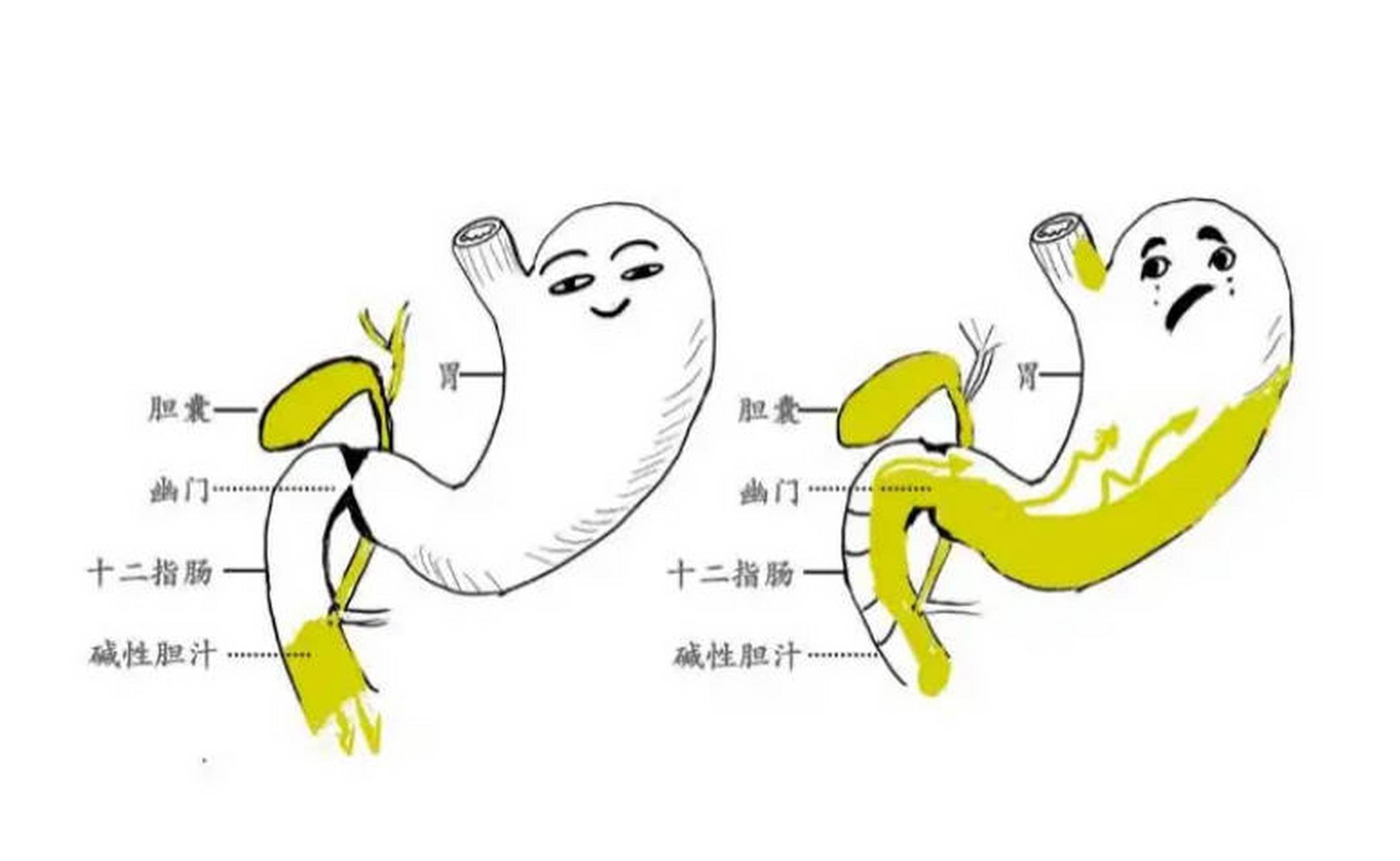 不管你是胆汁反流还是反流性食管炎,都怕这四味药,千万不要再瞎折腾了