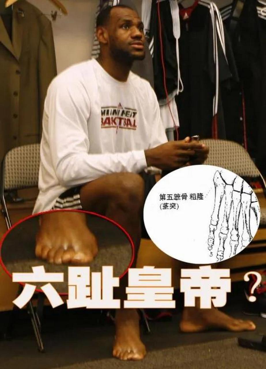 詹姆斯竟然有6个脚趾头? 谁来说说真的还是假的? #nba吐槽大会