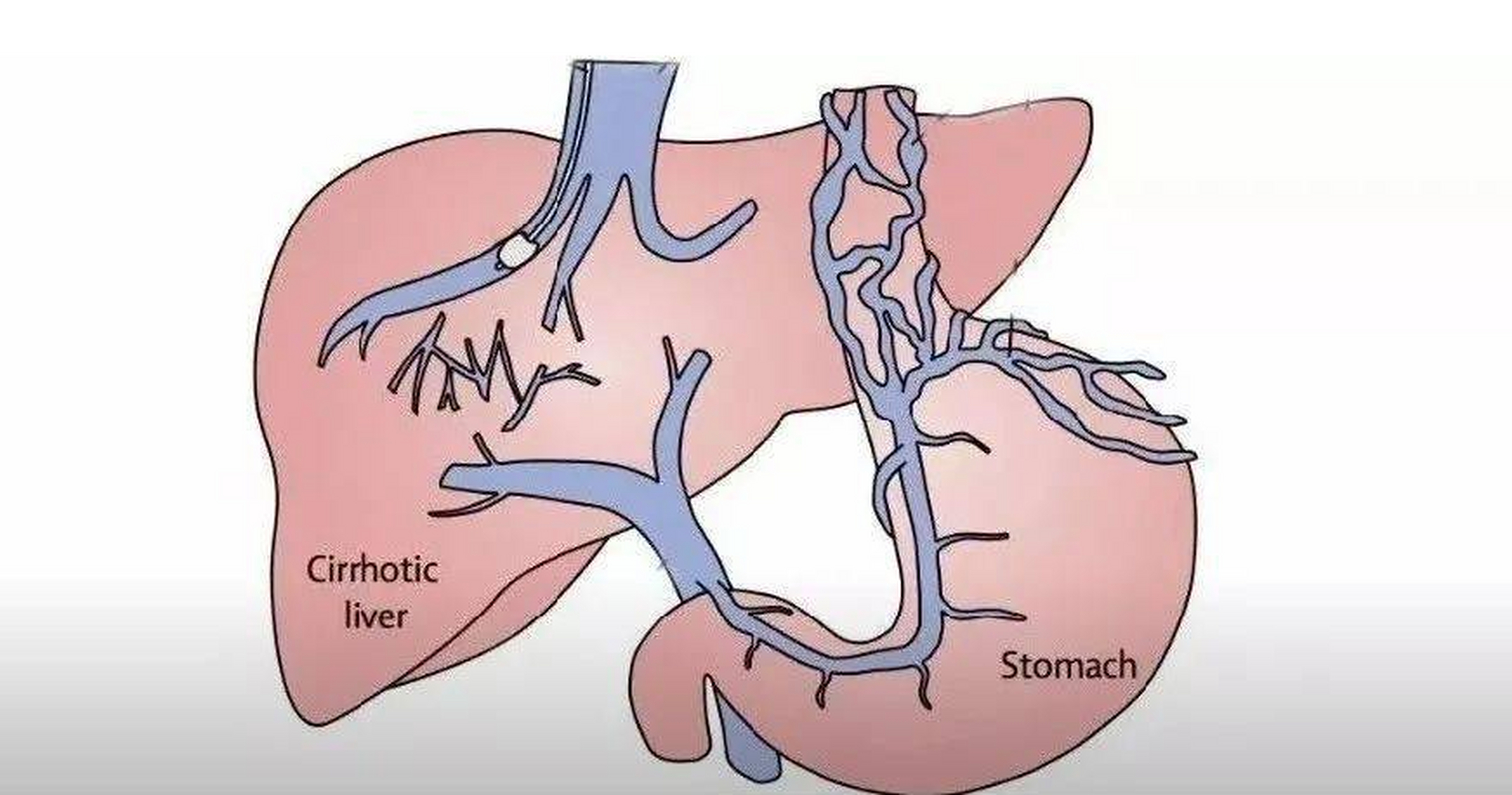 肝硬化并发症门静脉高压有哪些危害?