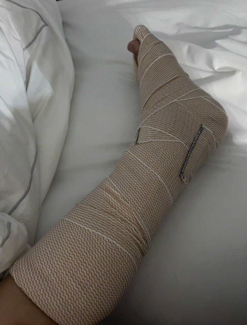 腿打石膏,满头白发,这是发生了什么事吗?#九月动态激励计划