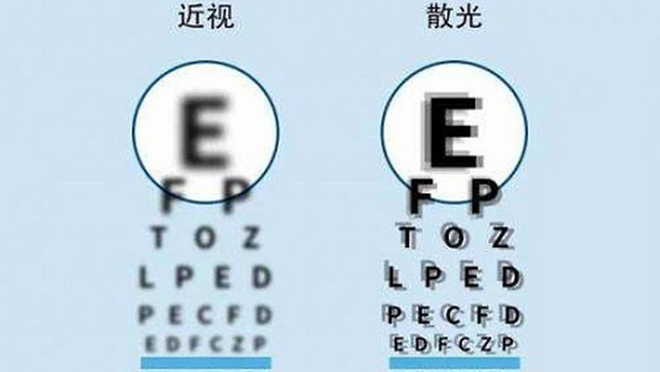 近视# #散光# #近视眼# #眼睛#   散光和近视都属于屈光不正,近视是