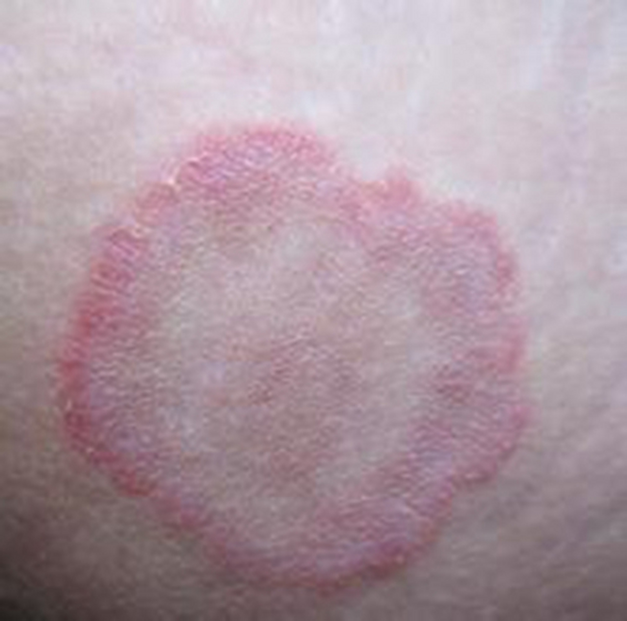 男人得了这3种病都会难以启齿,尤其是第2种.