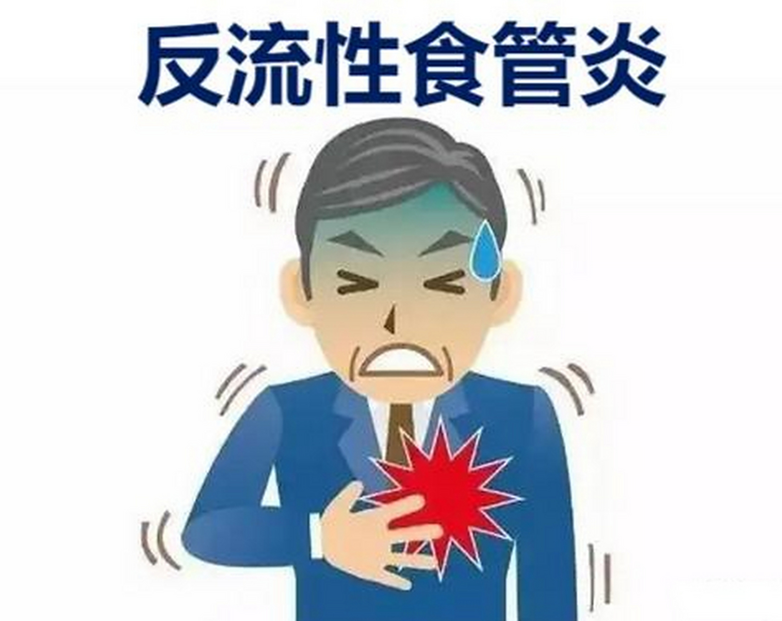 反流性食管炎是一种常见的消化系统疾病,常表现为胃酸倒流至食管移痧