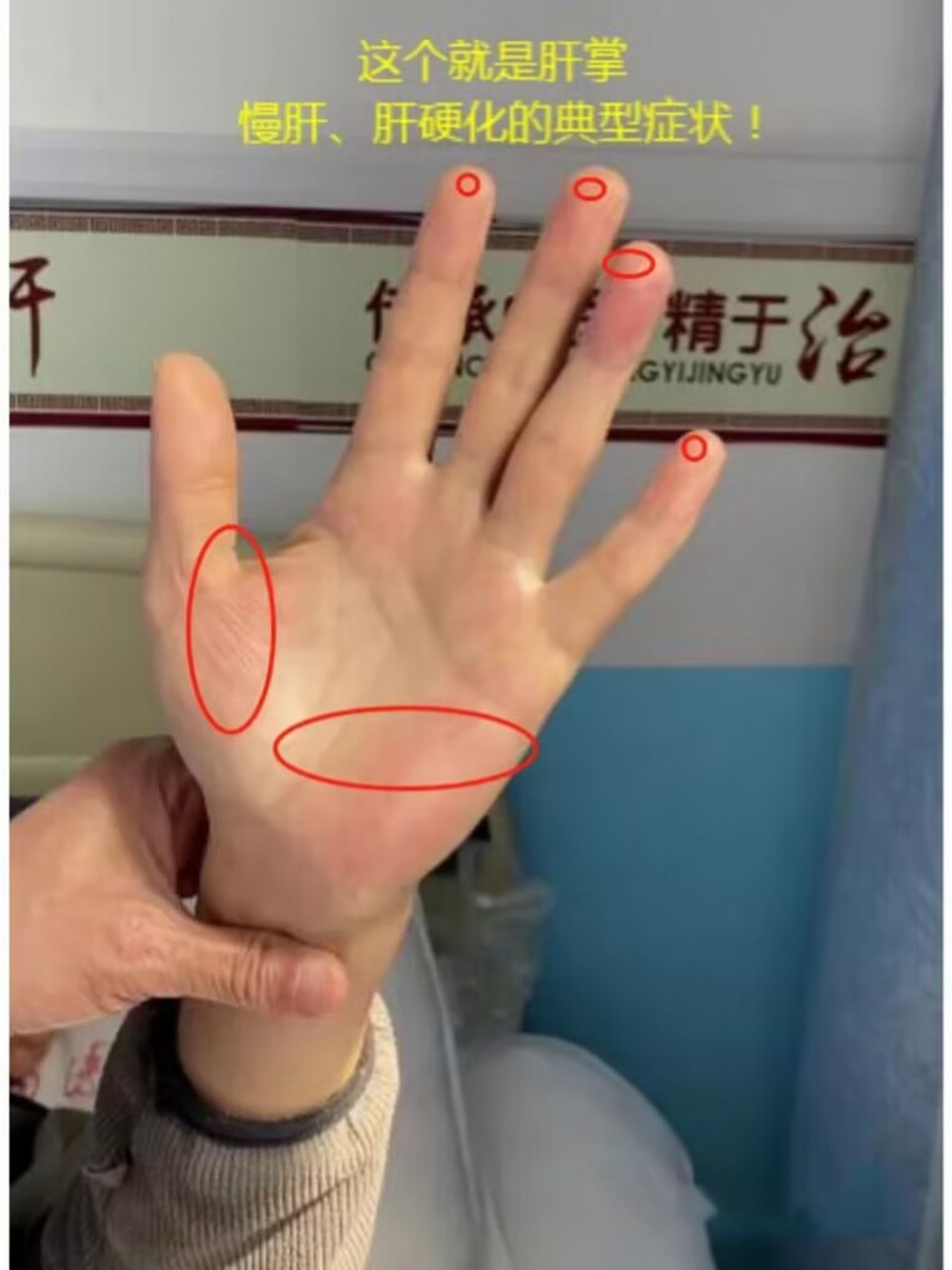 上午大查房,学生举着患者的手问我这是肝掌吗,很明显,手掌大小鱼际