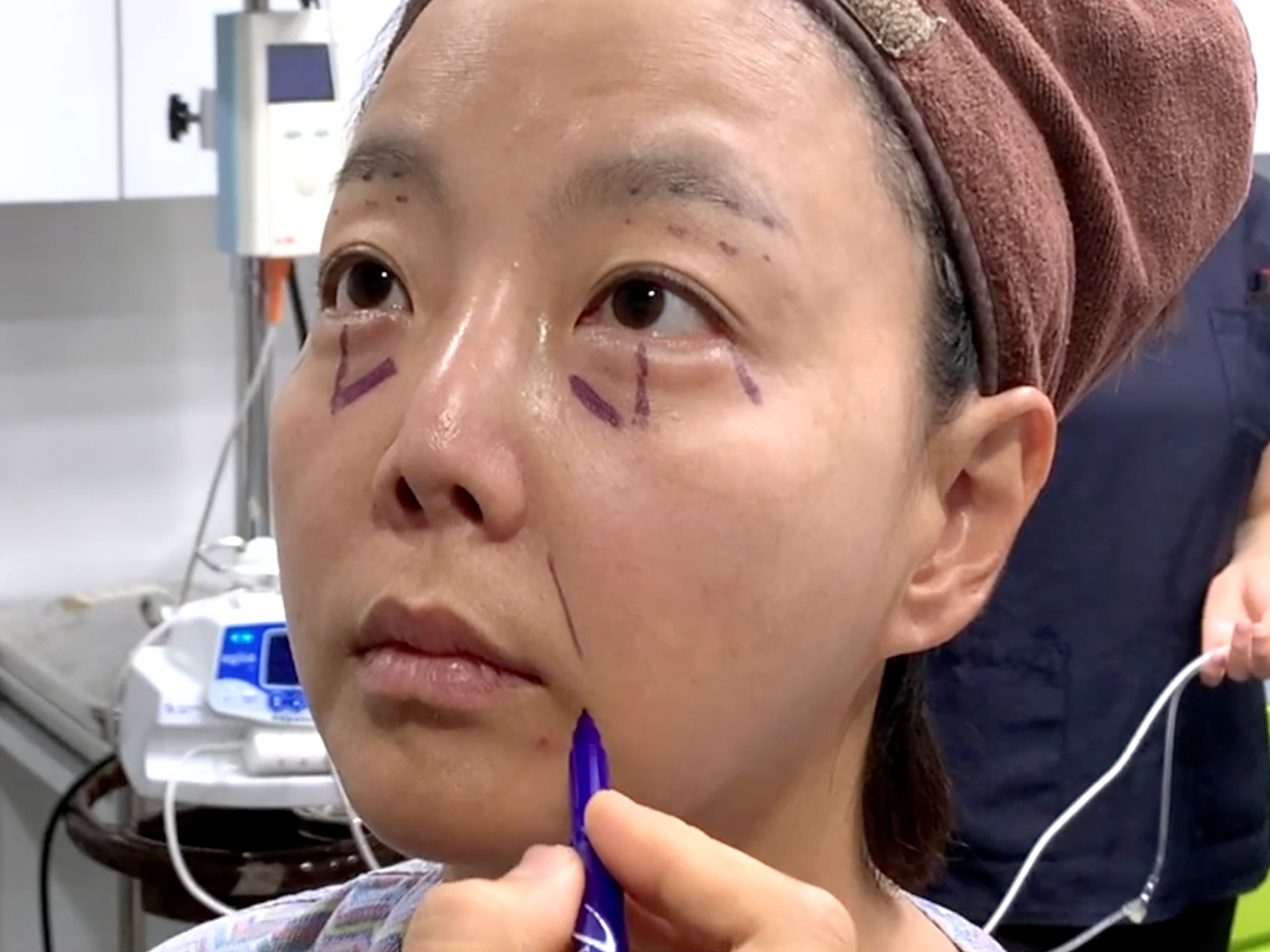 切眉手术选择眉上切口还是眉下切口?