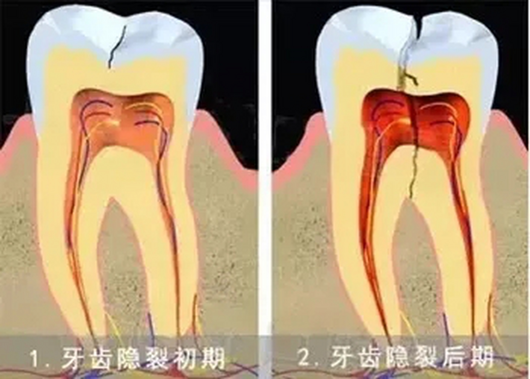 牙齒早衰之牙齒表面無光,裂痕!