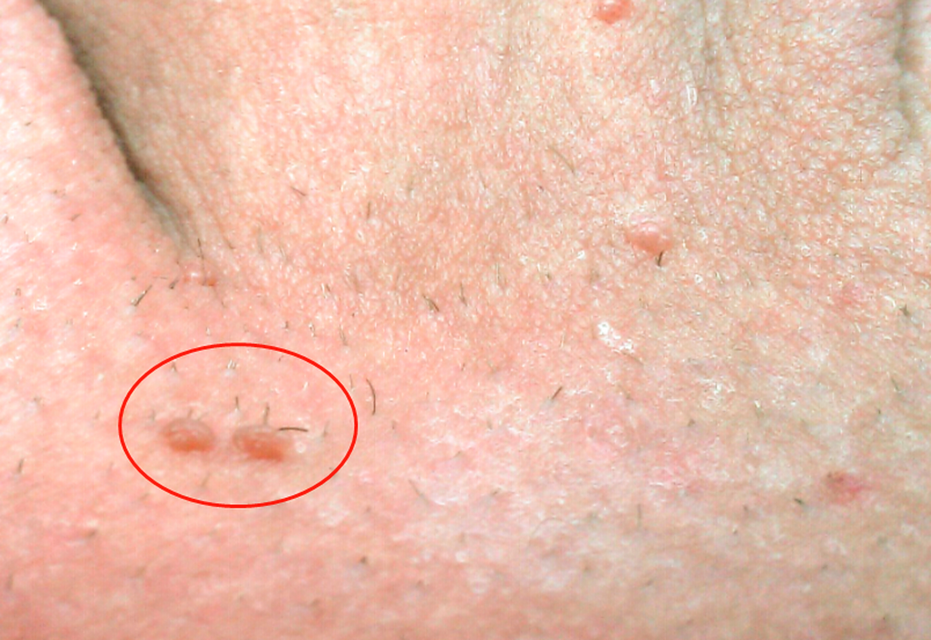 "朱老师,我是不是得了尖锐湿疣?