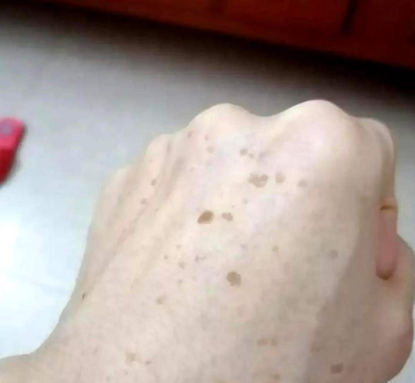 虽然我的皮肤上有类似老年斑的斑点,但我才30岁.