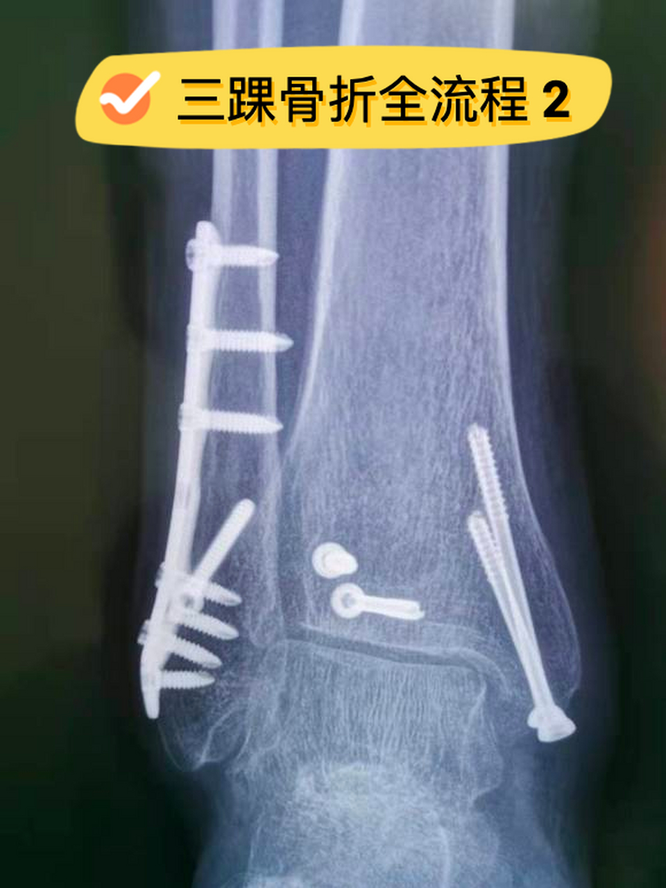 三踝骨折全流程问题全解----取钢板,术后恢复,下地 21566 #骨折