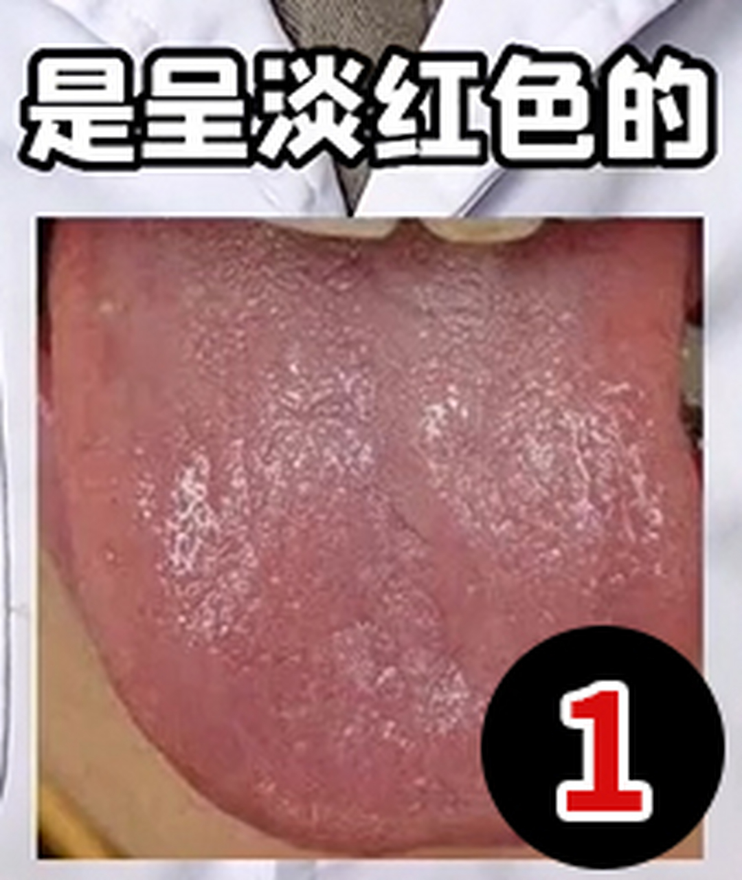 正常的舌象是呈淡红色的,苔薄白(图一),     胃气不足,舌苔中间就会有