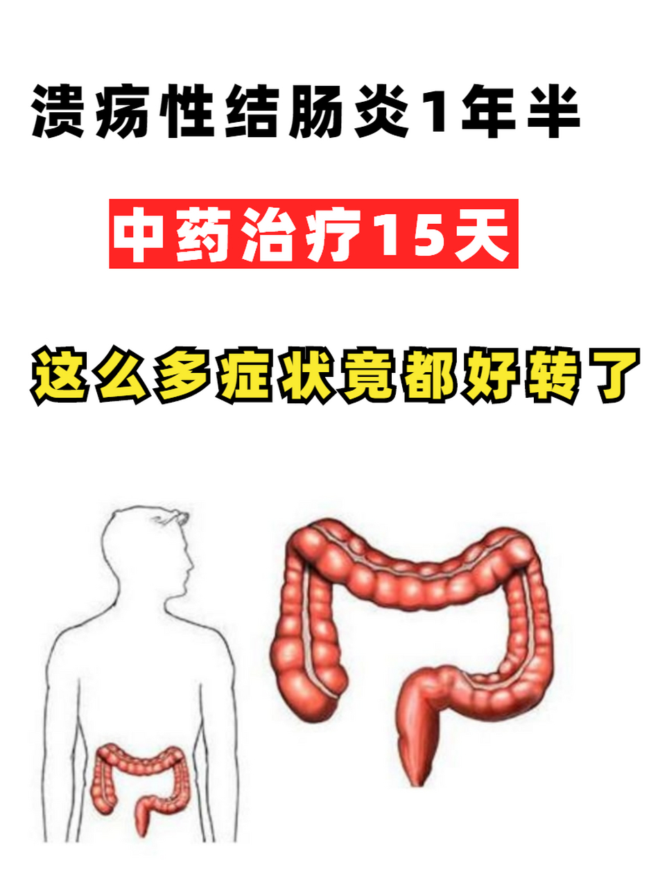 49岁杨女士,溃疡性结肠炎1年半,用药半个月所有症状都好转了!