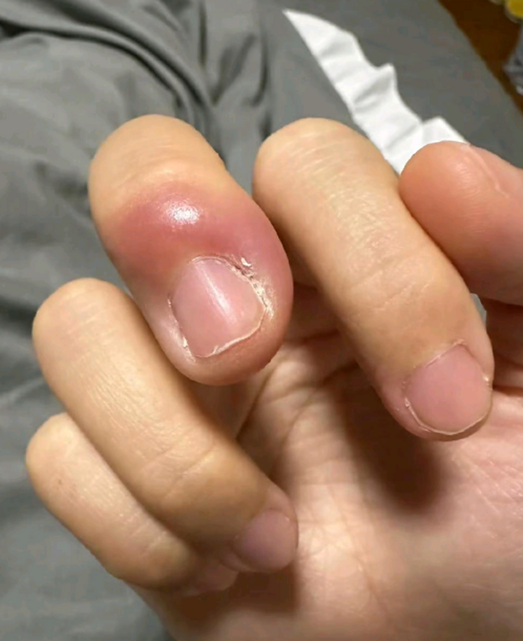 拔个倒刺这么严重的吗