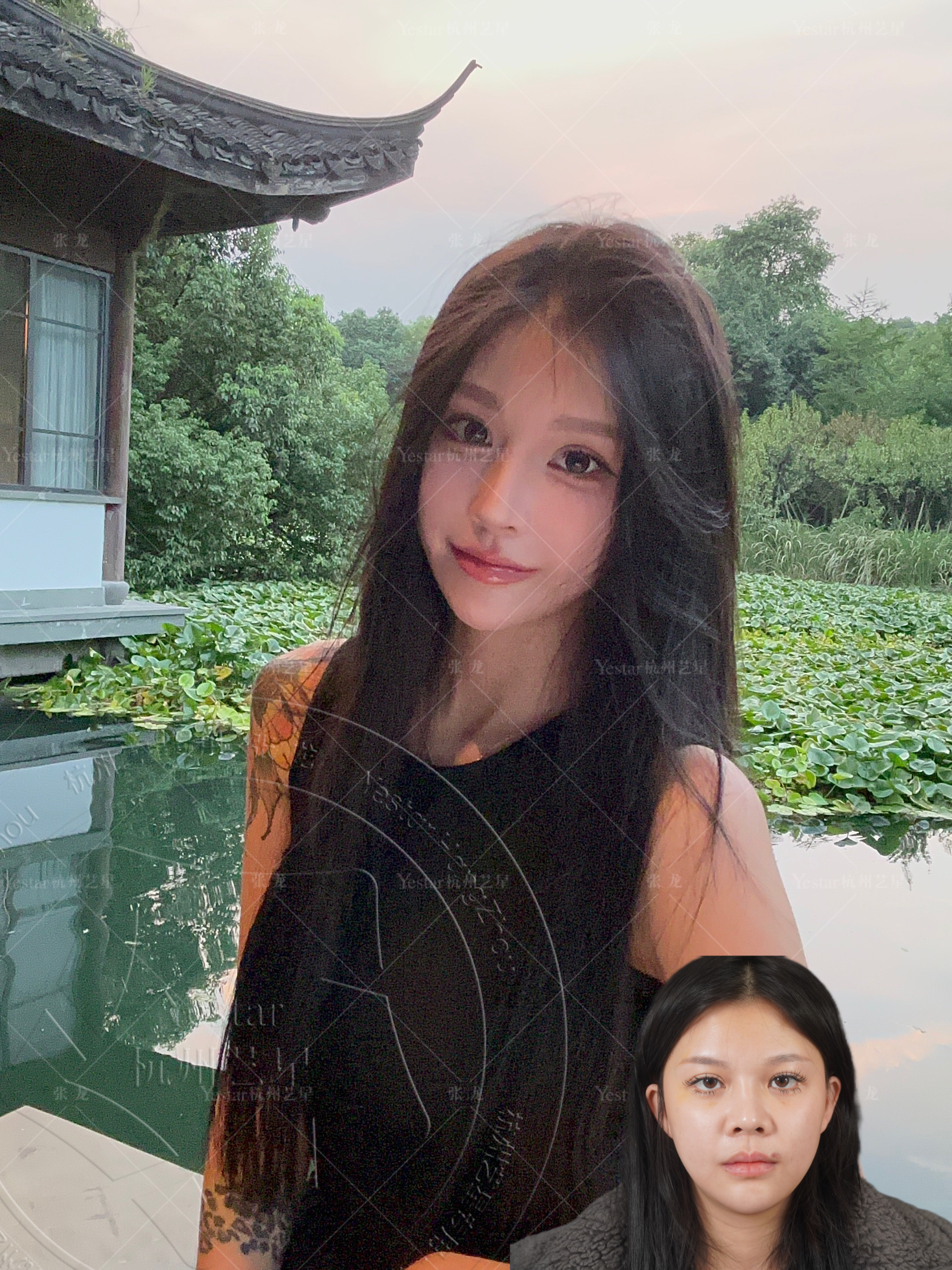 肋软骨隆鼻 精致款直鼻微翘 术后7个月返图 #张龙隆鼻# #张龙鼻综合