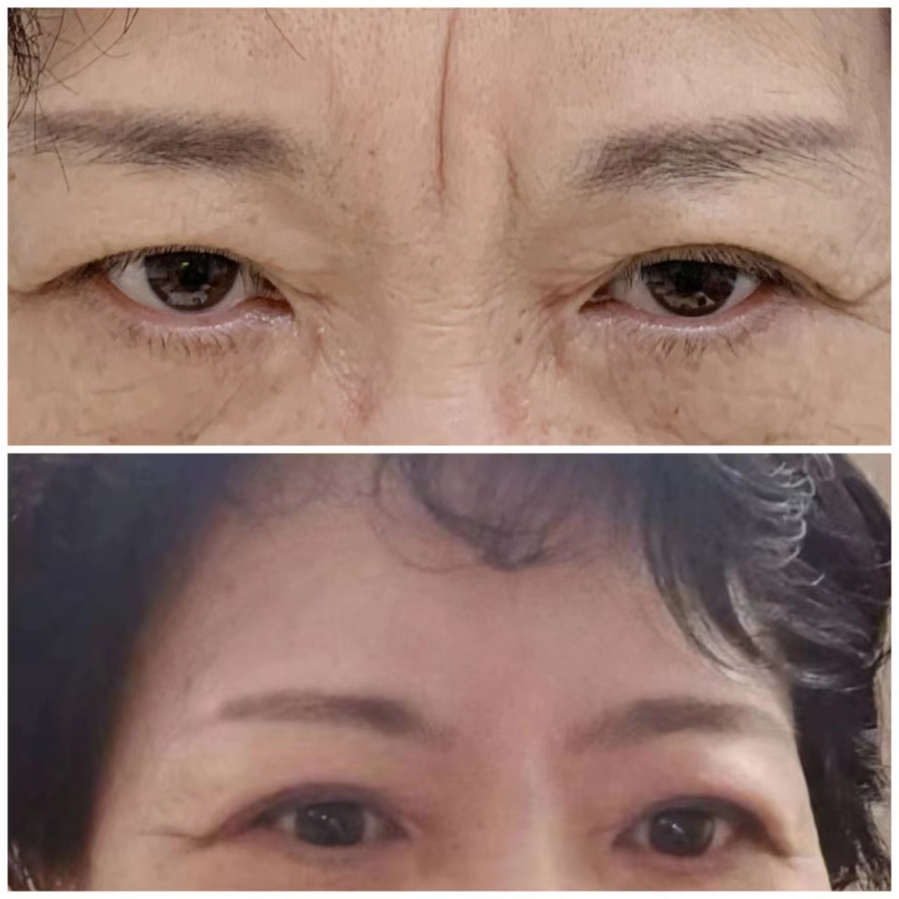 印堂川字纹,一定及早打除皱.除皱针有效抑制肌肉的运动.