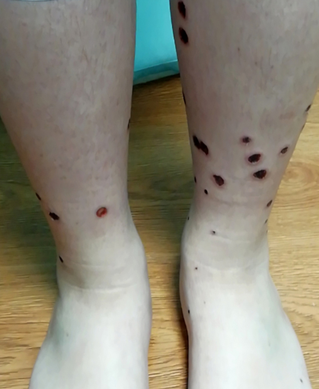 当过敏性紫癜患者出现皮疹反复,且一次比一次出现的快,间隔越来越短