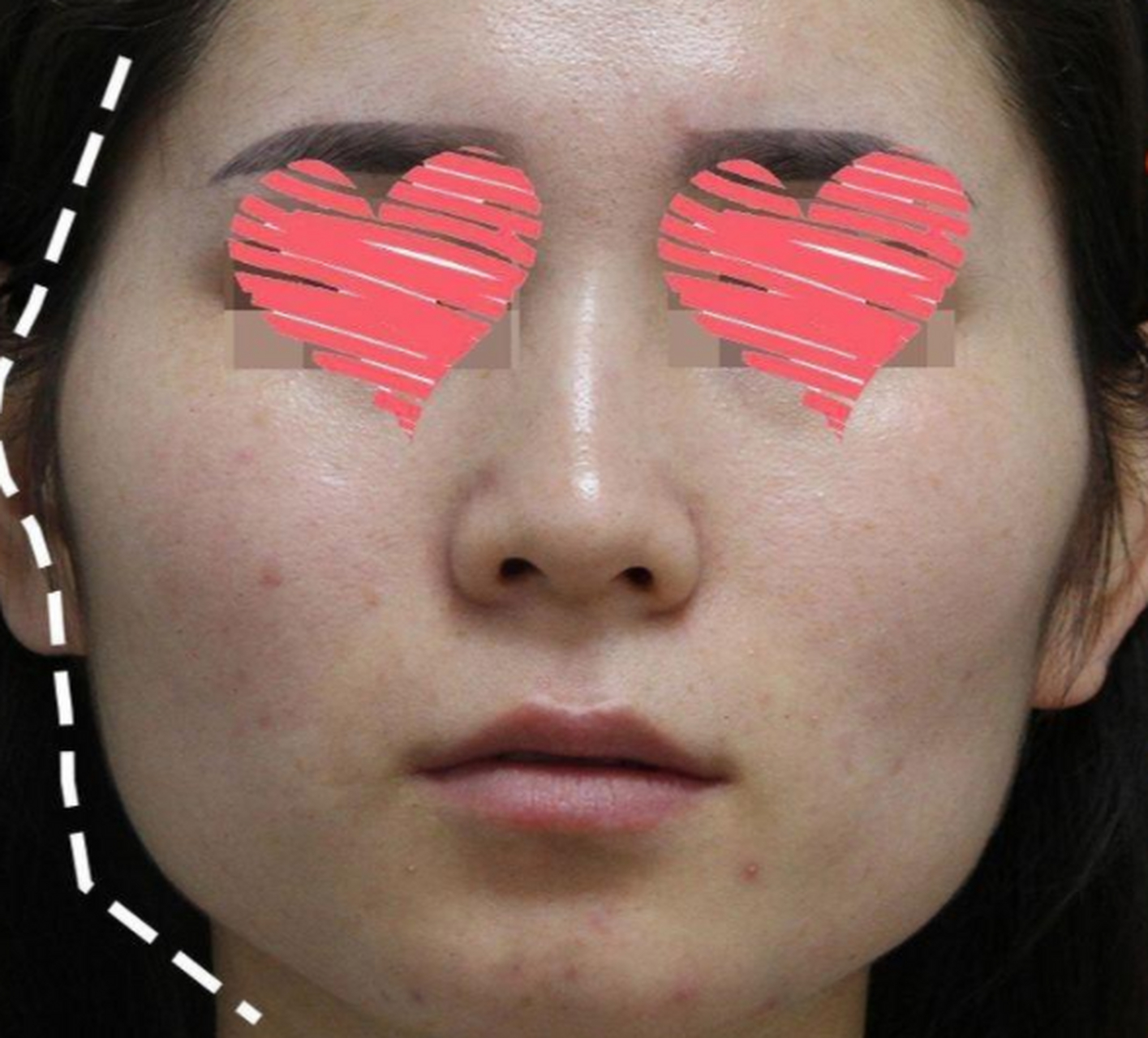 颧骨颧弓整形术是什么?