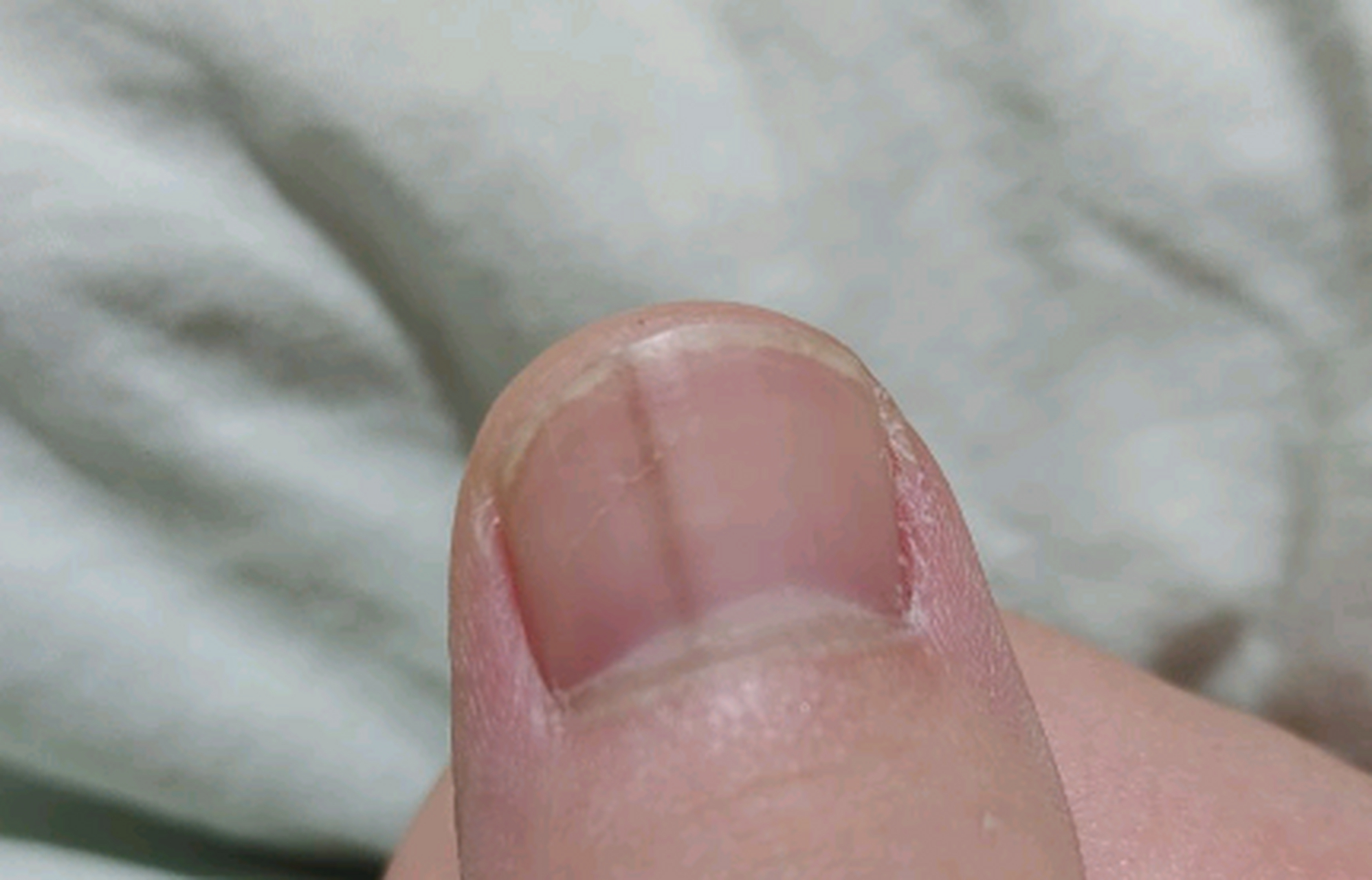 为什么指甲中间出现了黑线,是灰指甲的前兆吗