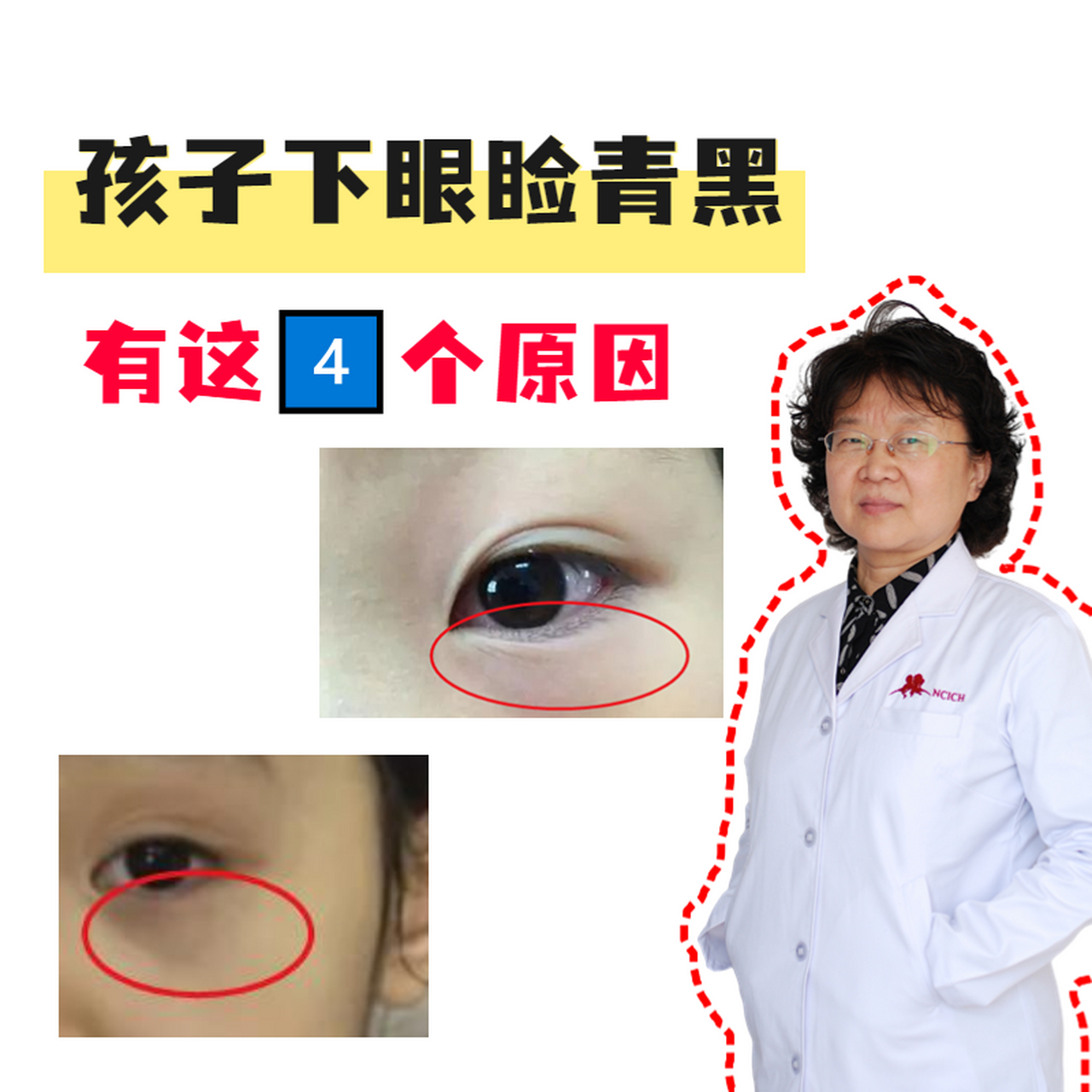 96孩子下眼睑青黑,有这几个原因:  73一是脾虚积食,即"积滞".