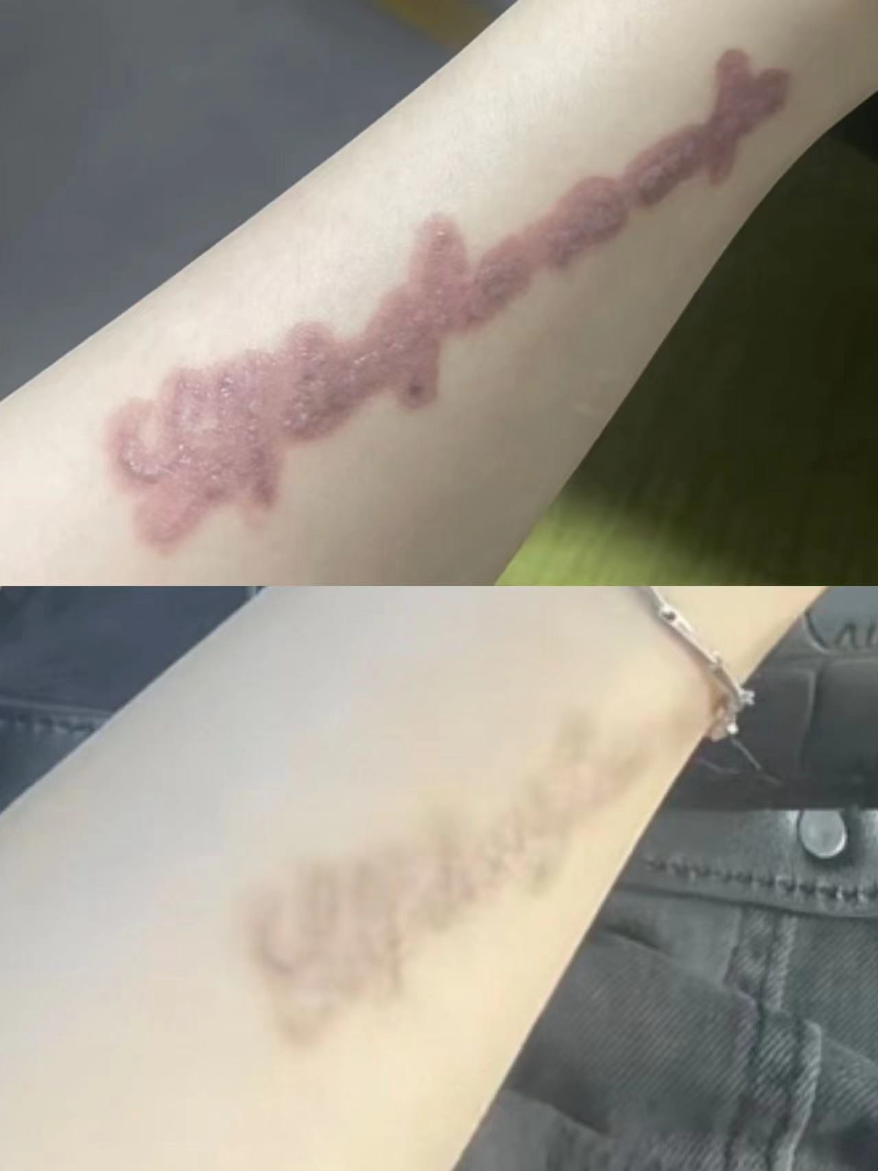 洗纹身是有一定可能会留疤的,不过也不要太过于担心,不好看不健康