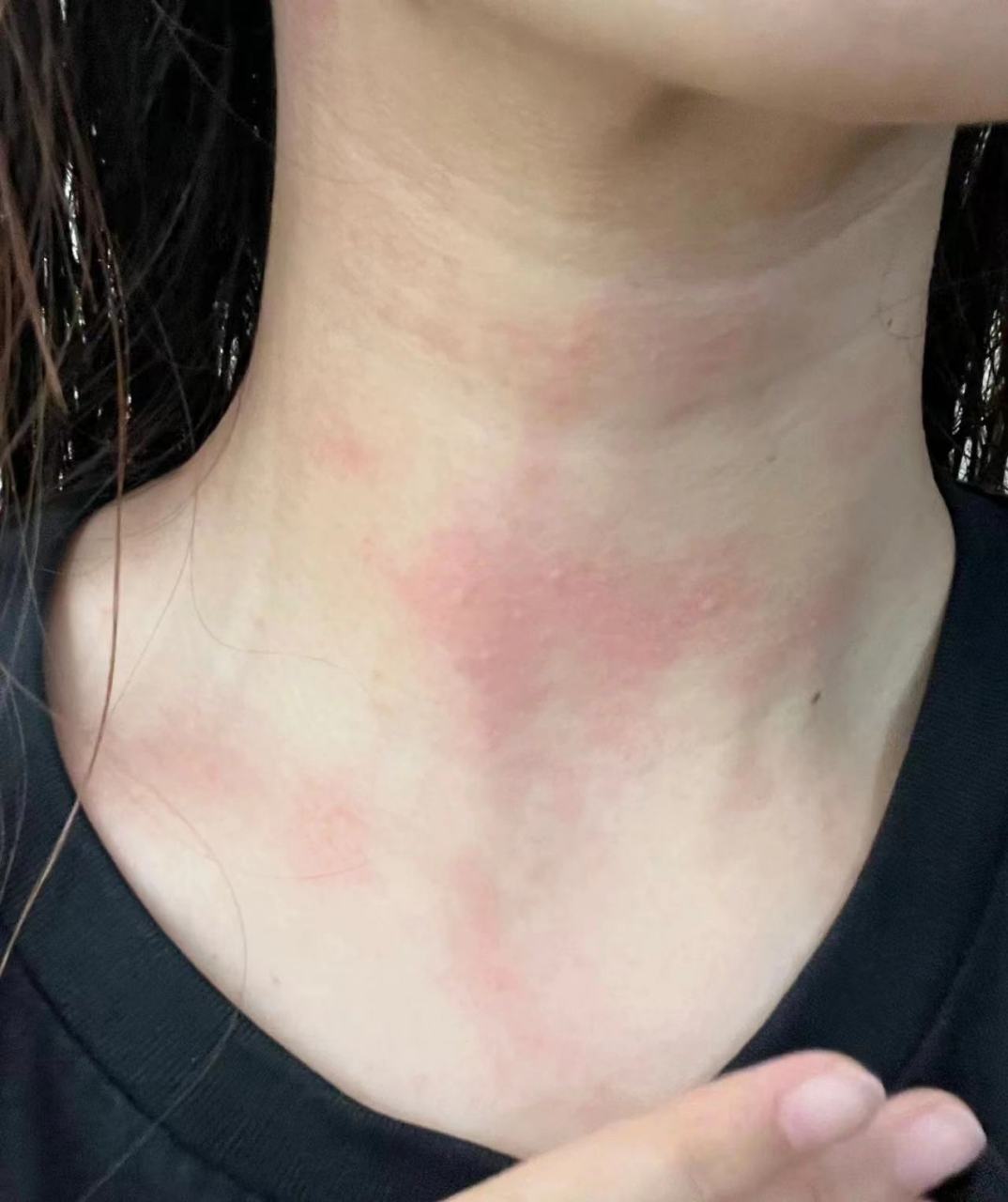 过敏性皮炎顾名思义就是过敏引起的皮炎. 那么它的表现呢?