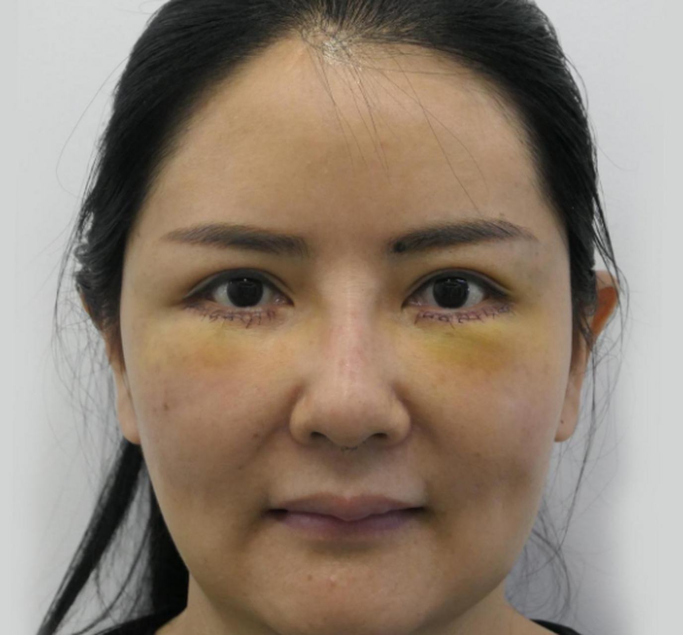 第一张:泪沟凹陷的很明显,十分显老,给人一种沧桑感; 第二张:术后4天