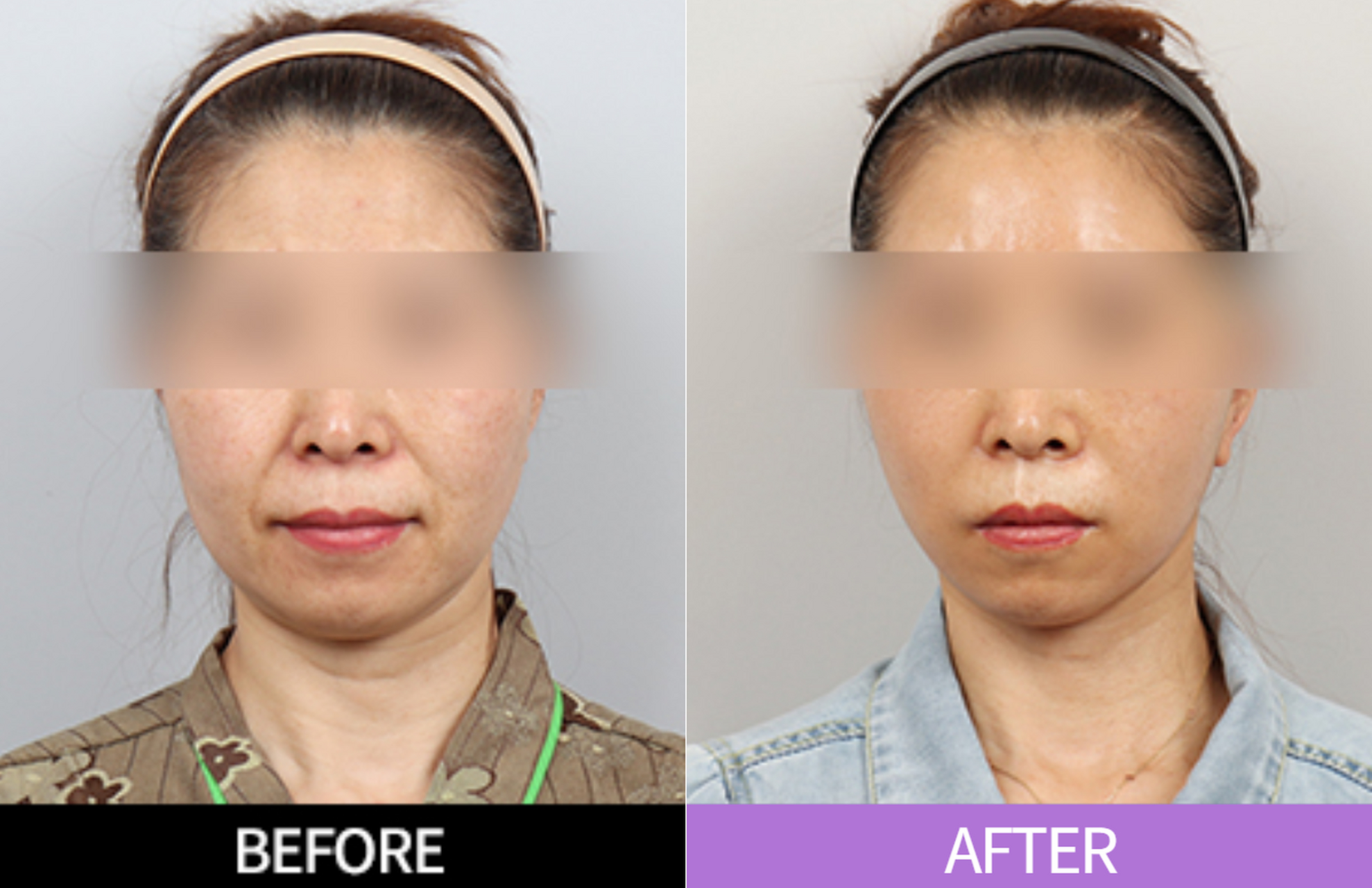 苹果肌下垂和鼻基底凹陷引起的法令纹加深问题,只做单独的填充,效果