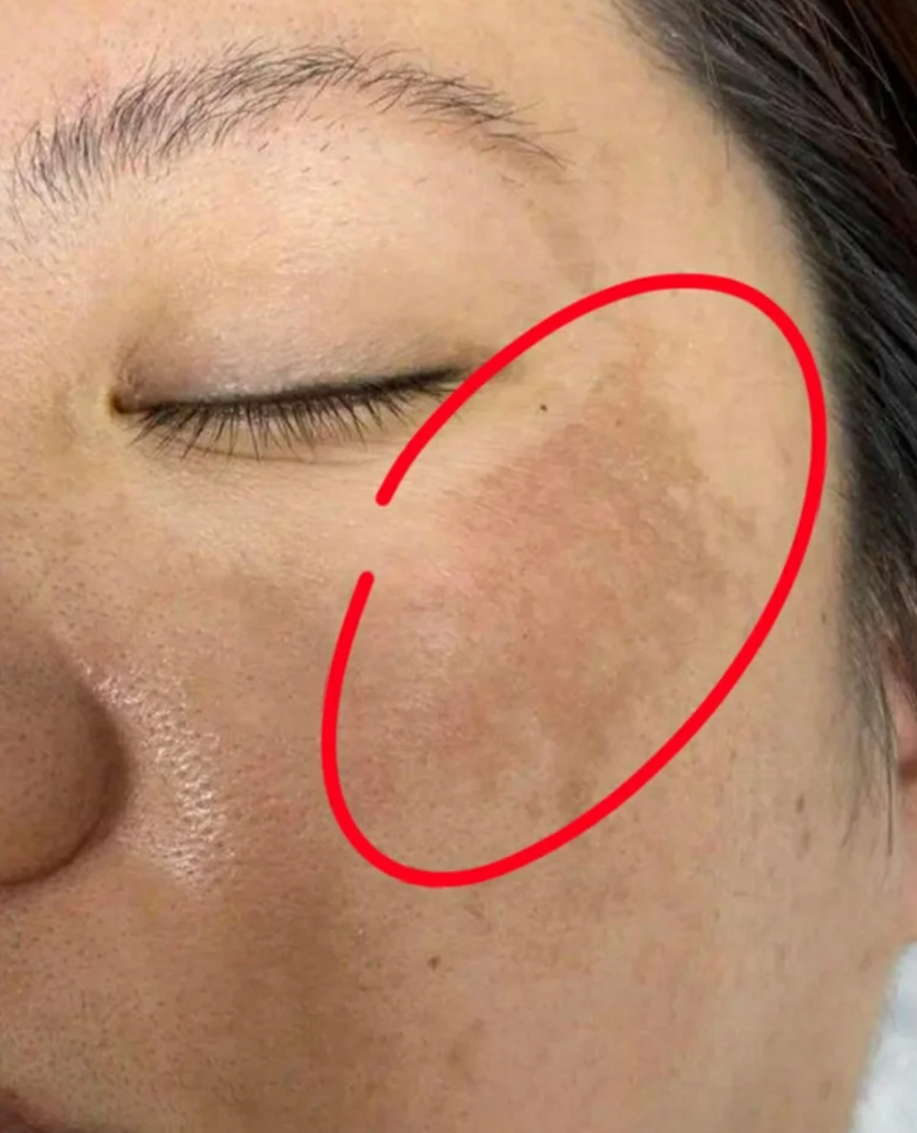 脸上大片黄褐斑怎么治疗最好 #医美科普挑战赛#  脸上出现大片黄褐斑