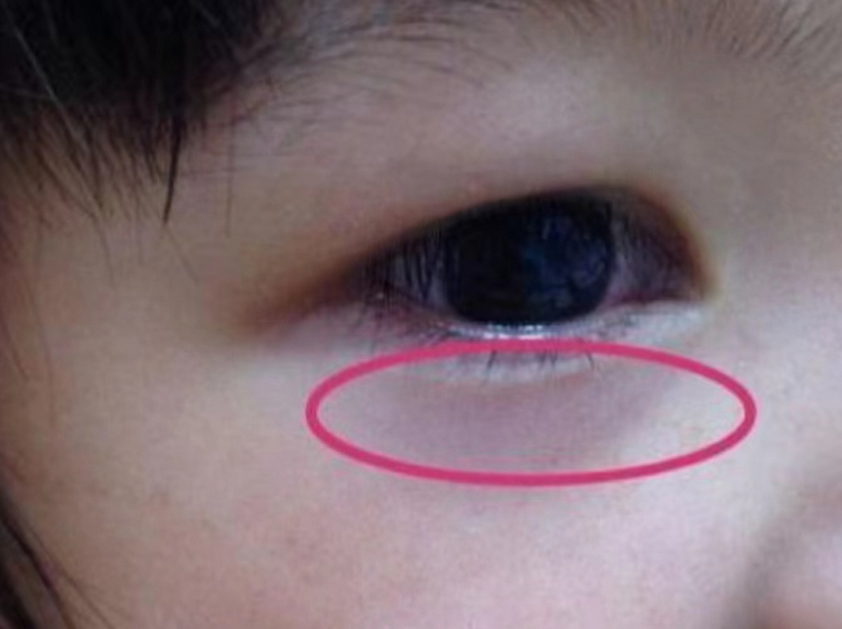 过敏性鼻炎可能会导致黑眼圈  是的,病理性因素也会导致孩子出现黑