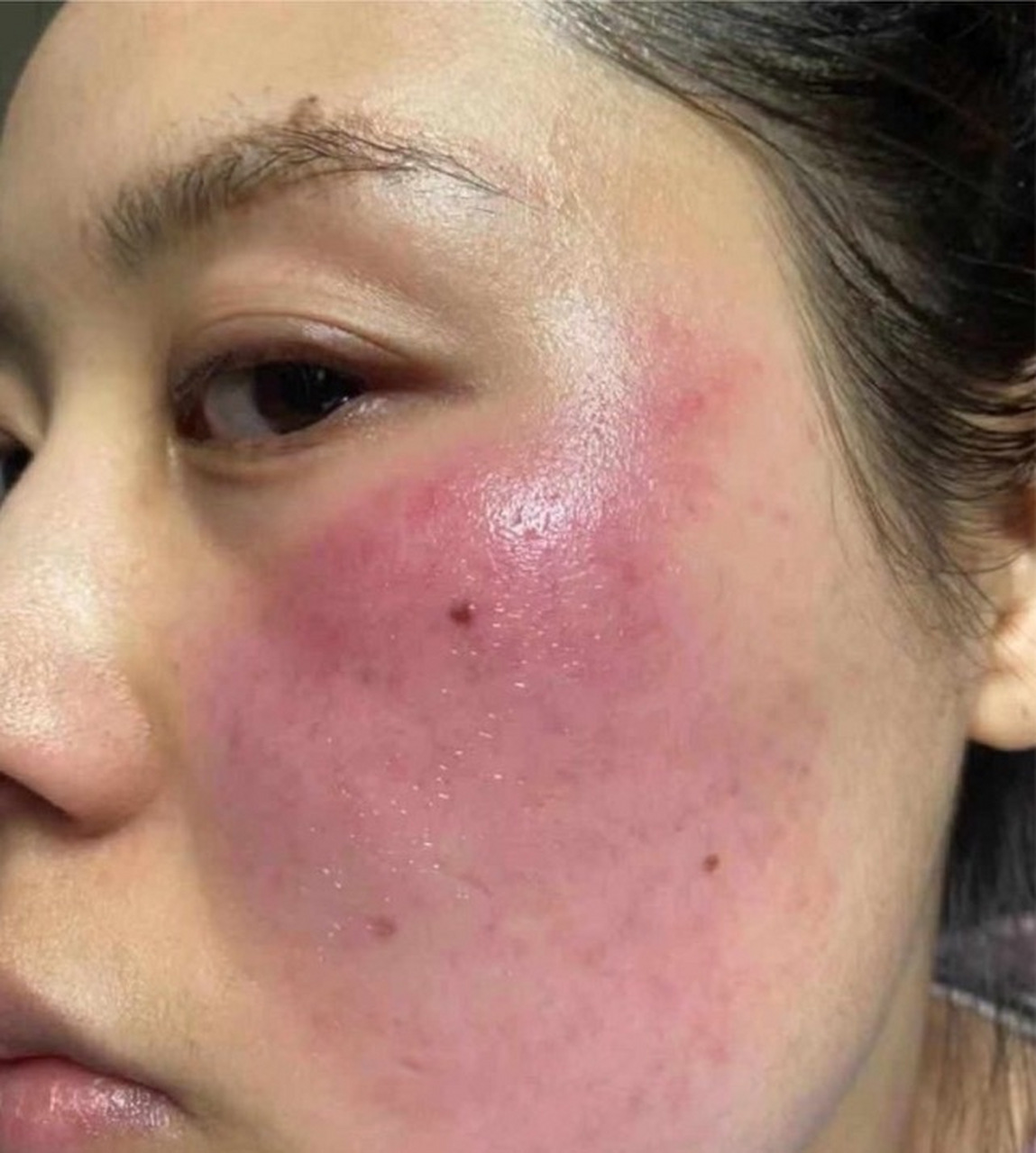 玫瑰痤疮是一种常见的慢性皮肤病,通常会影响面部,尤其是鼻子,颧骨