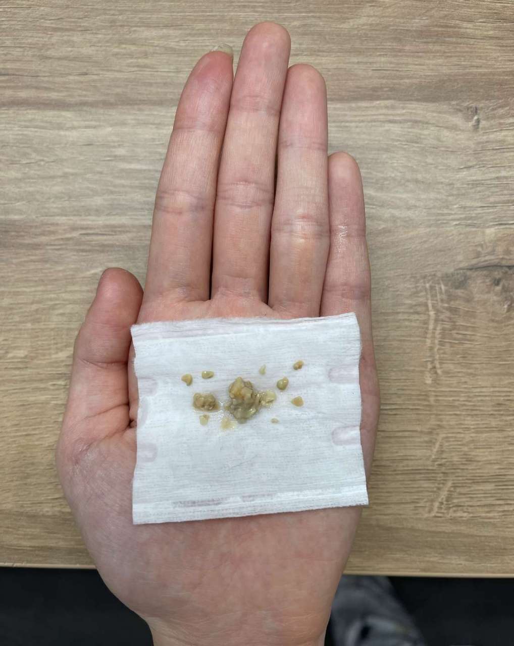 今天喉咙不舒服抠出这玩意儿