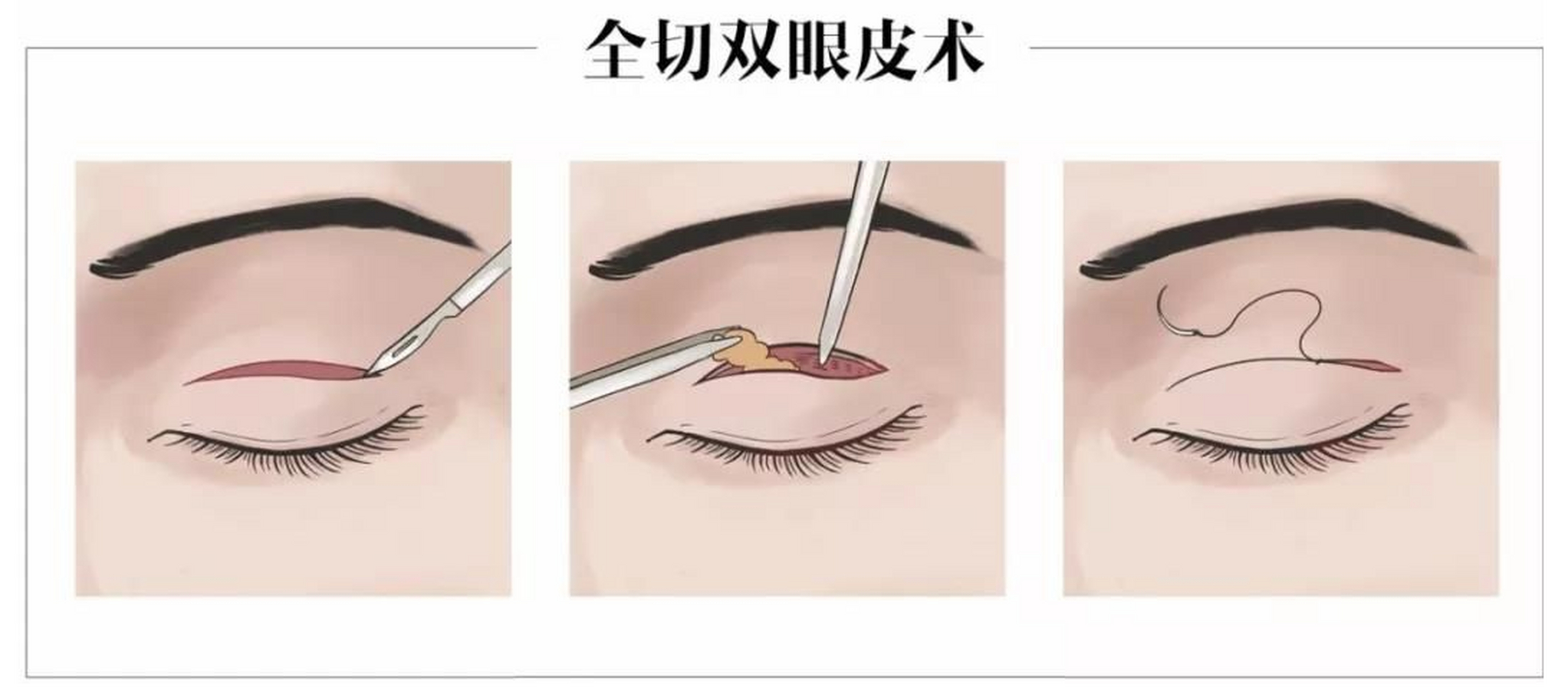 做全切双眼手术,疤痕多久能消失#全切双眼皮多久能恢复正常#  全切双