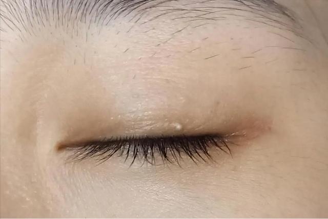 眼皮上长出小颗粒,又磨眼又难看怎么办?
