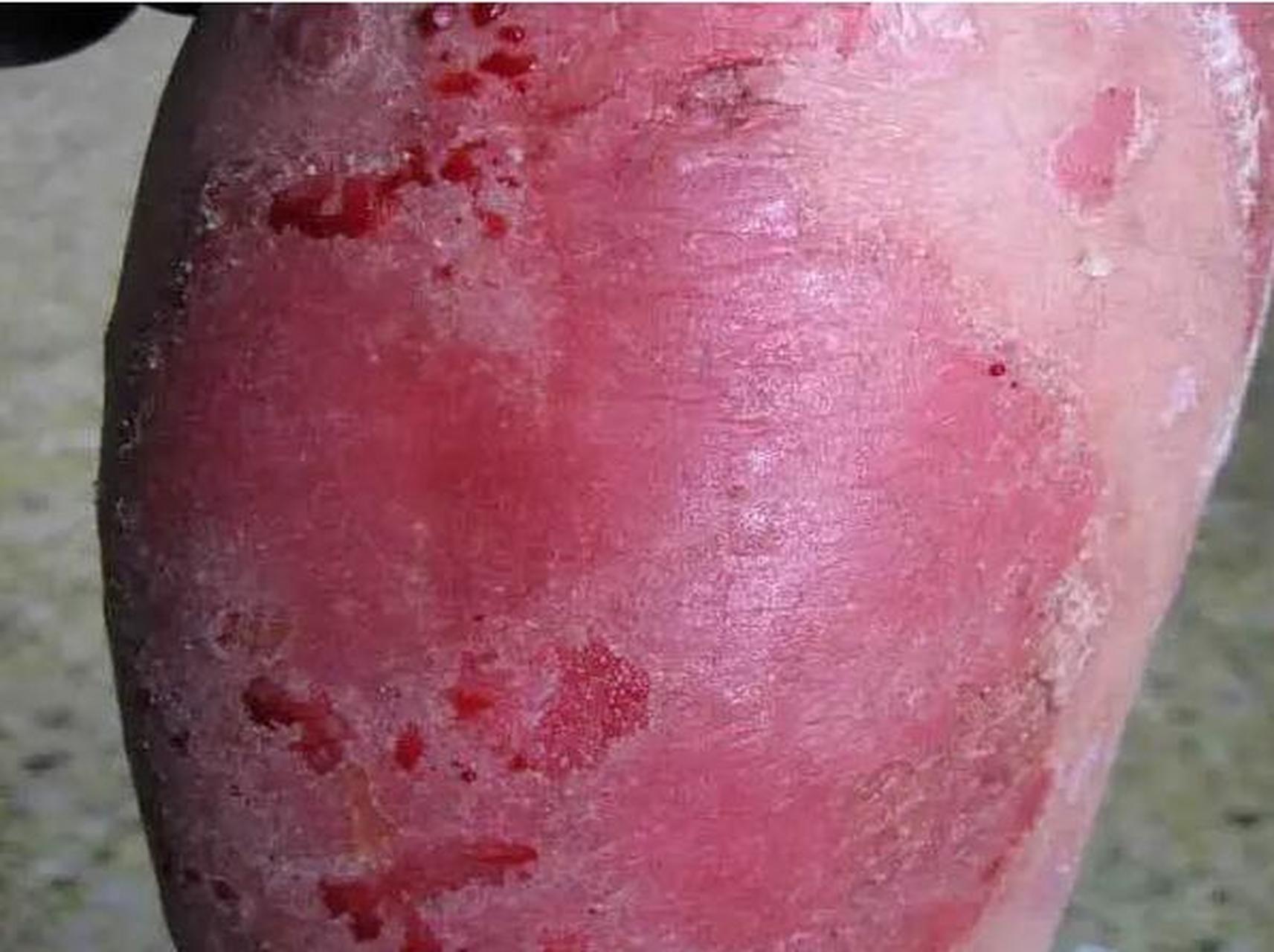 血热,血瘀,血燥,根据皮肤颜色,在家也能看银屑病  有不少银屑病朋友