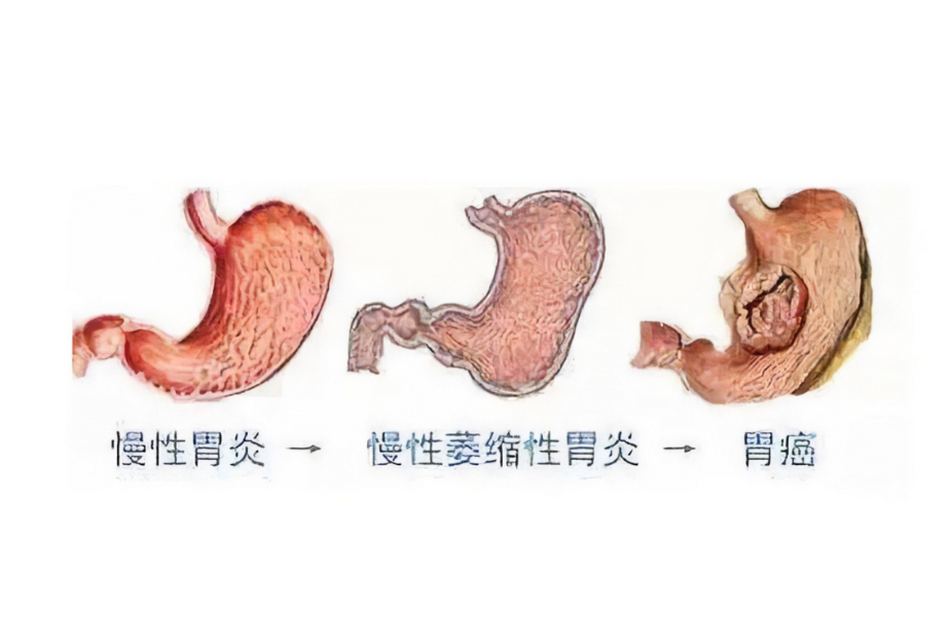 关于萎缩性胃炎,这些你了解吗?