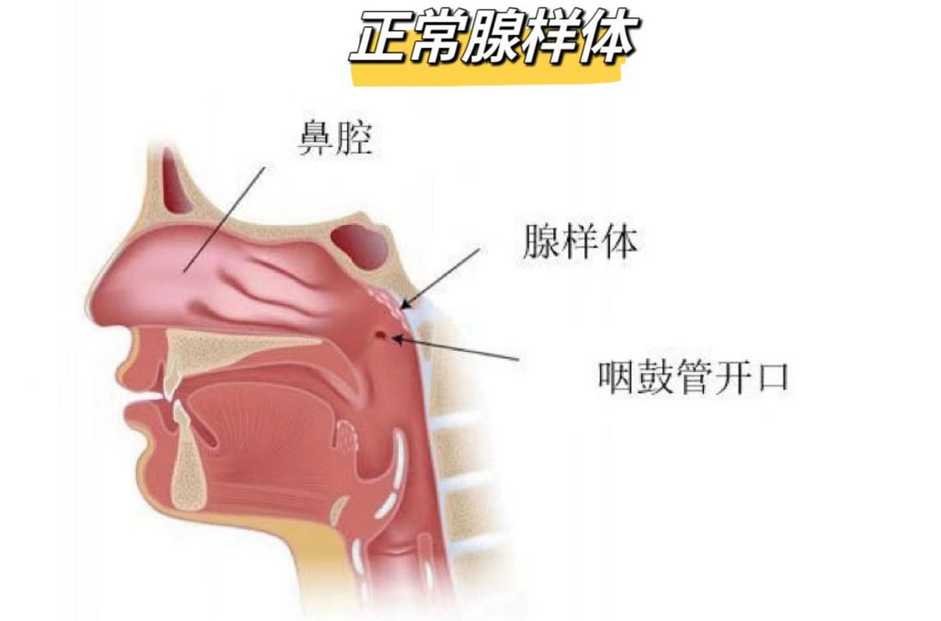 腺样体肥大,不妨先试试中医治疗,让孩子避免手术!