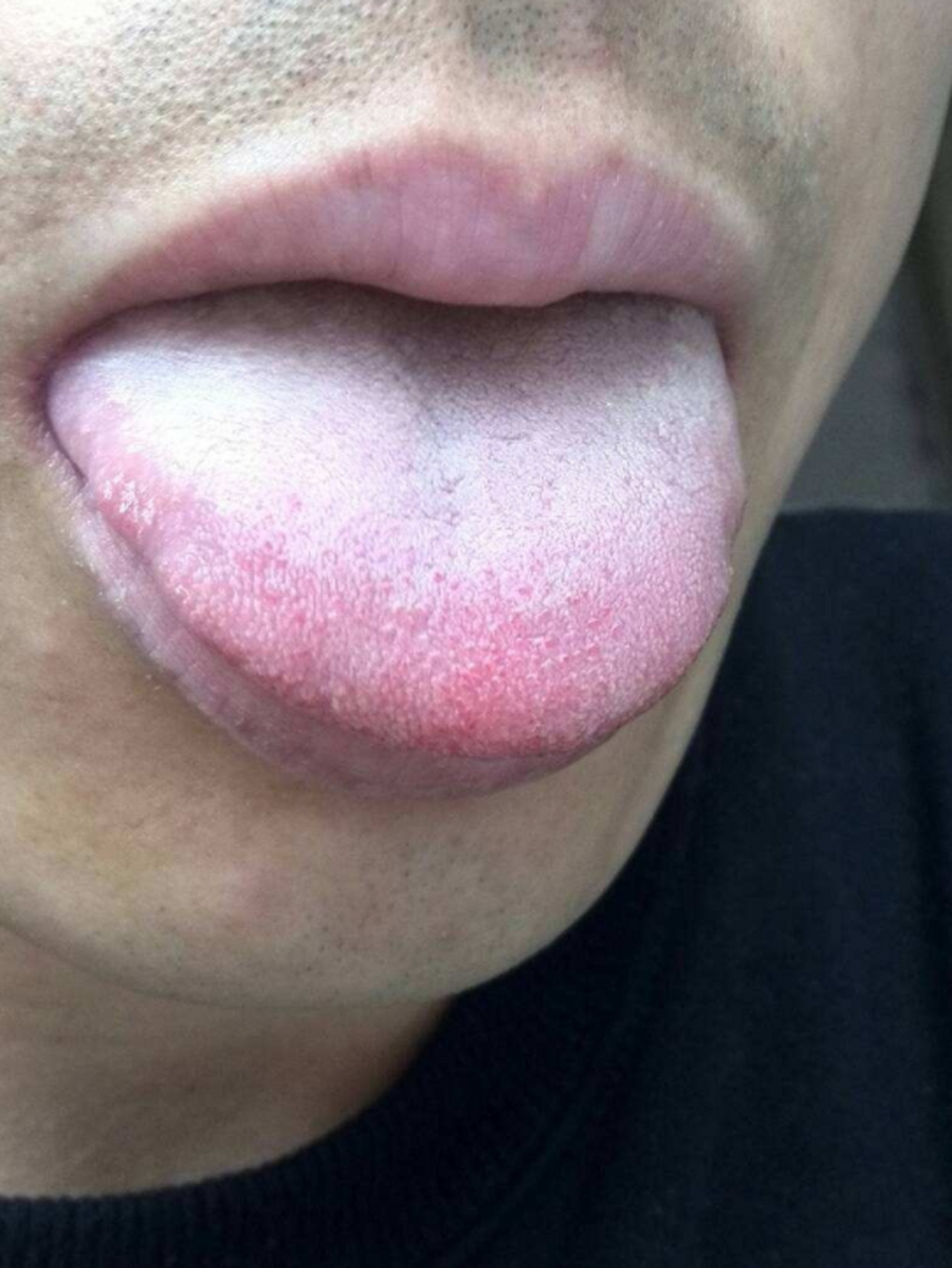 舌苔有灼烧的感觉——肠胃受损 舌头上有裂痕——脾虚湿气重 舌头颜色