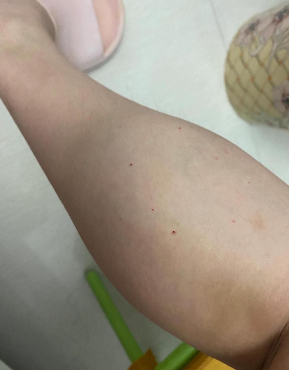 瘦脸针# 打个瘦腿针,腿被扎成筛子啦打了一针瘦腿针,腿部被扎得如同